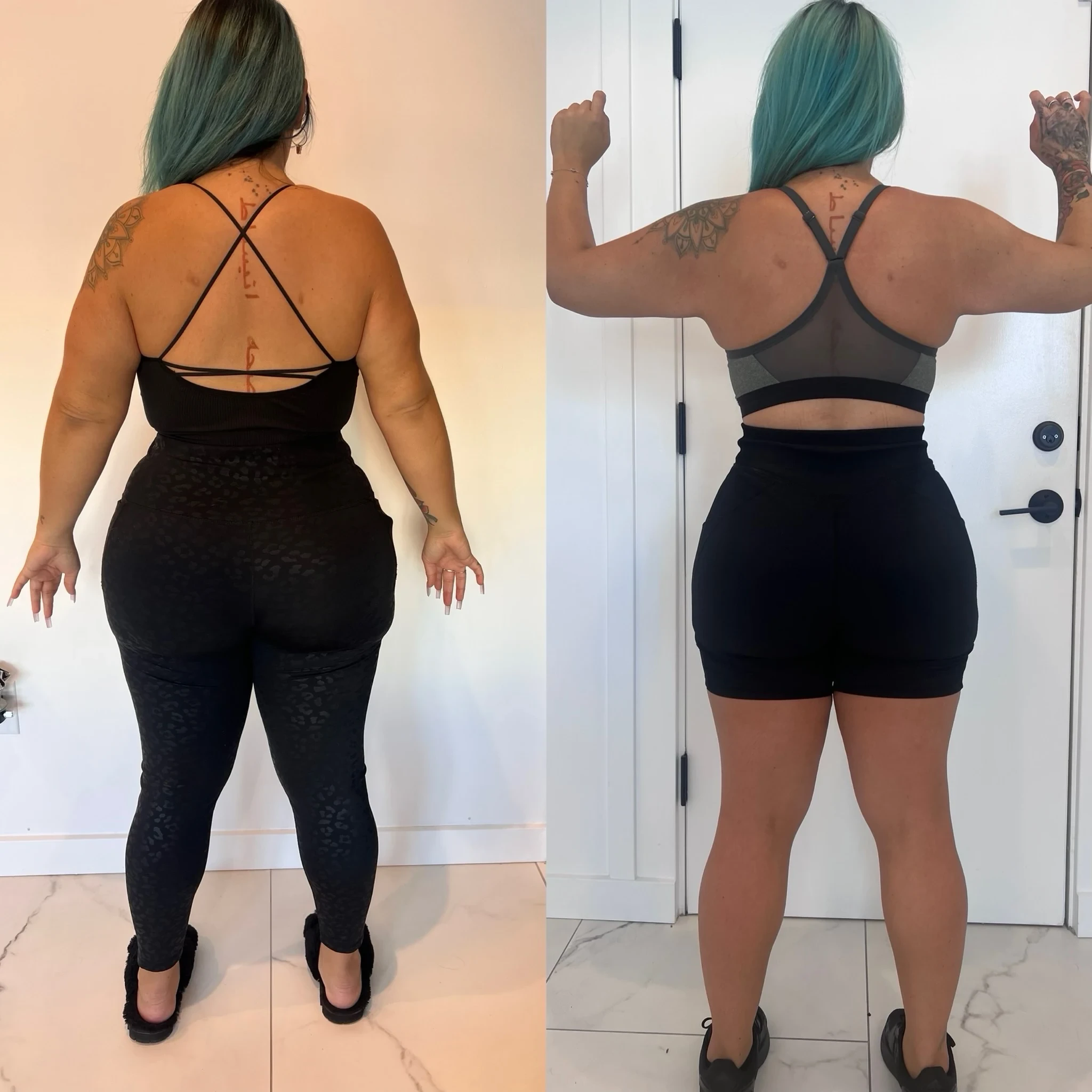 body contouring before and after in Phoenix