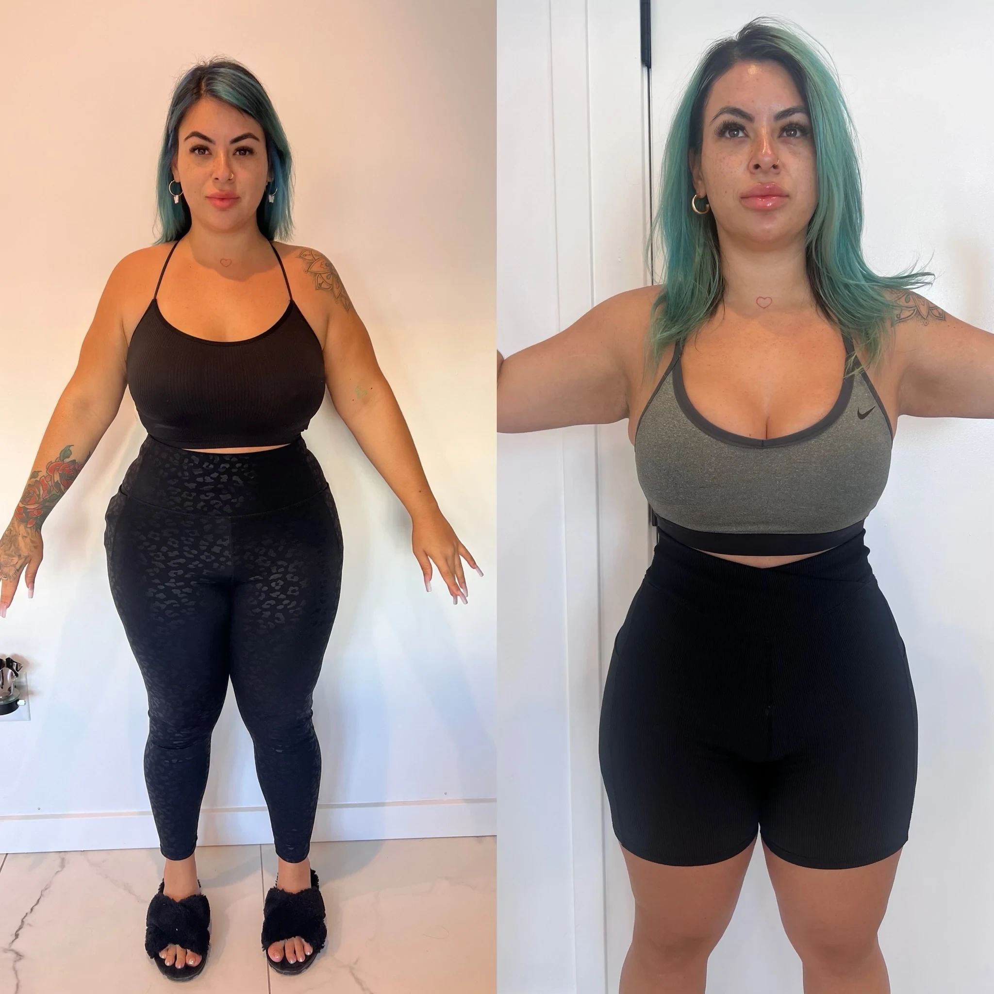 body contouring before and after in Phoenix