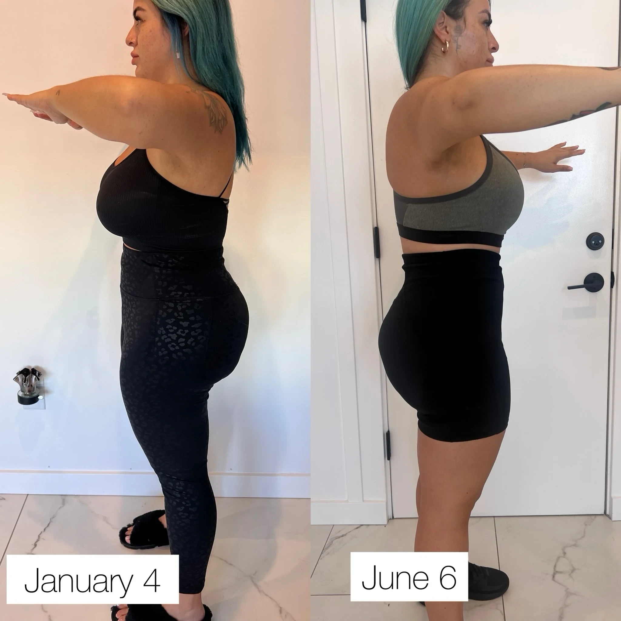 body contouring before and after in Phoenix