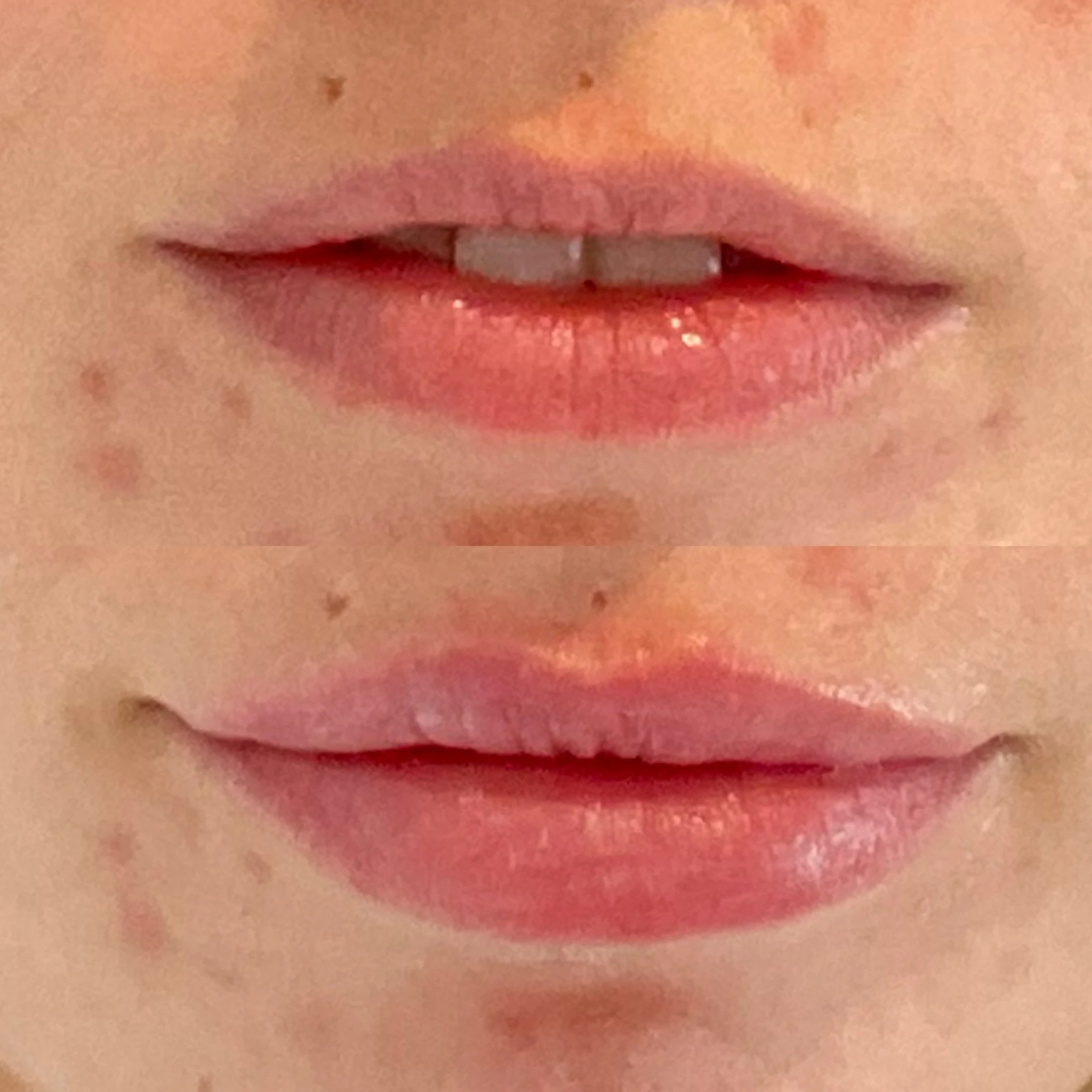 lip filler before and after in Phoenix