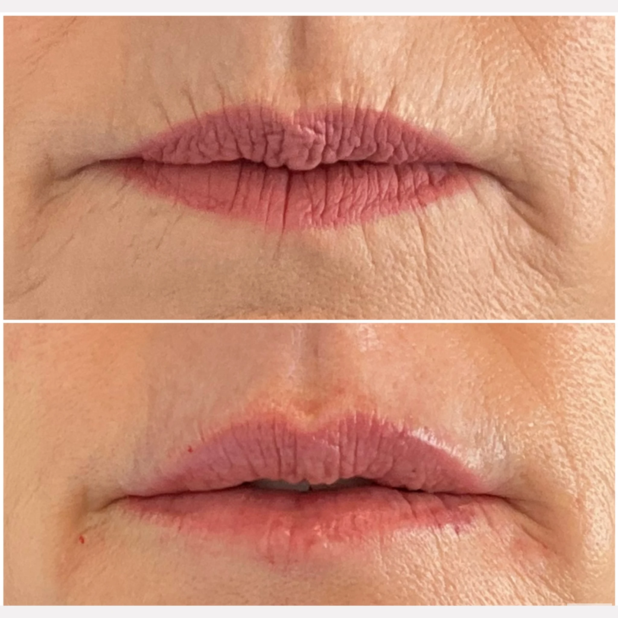 lip filler before and after in Phoenix