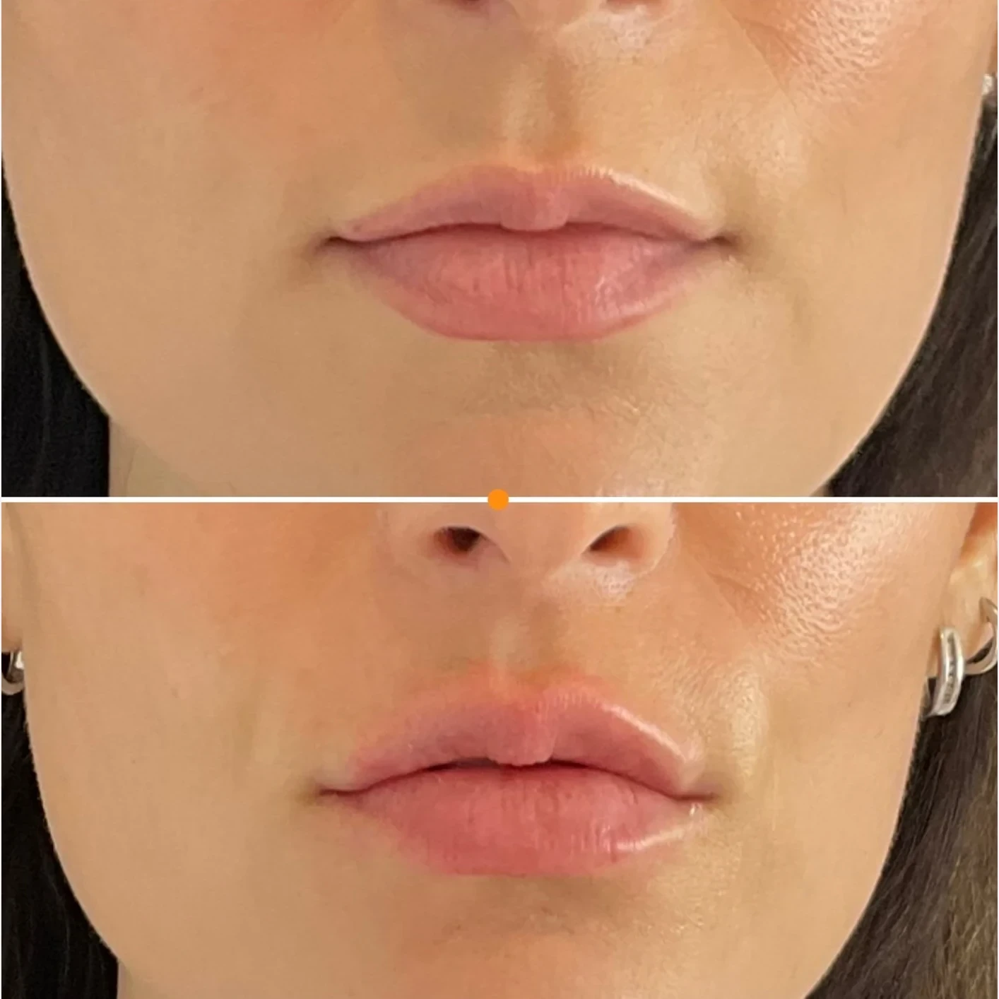 lip filler before and after in Phoenix