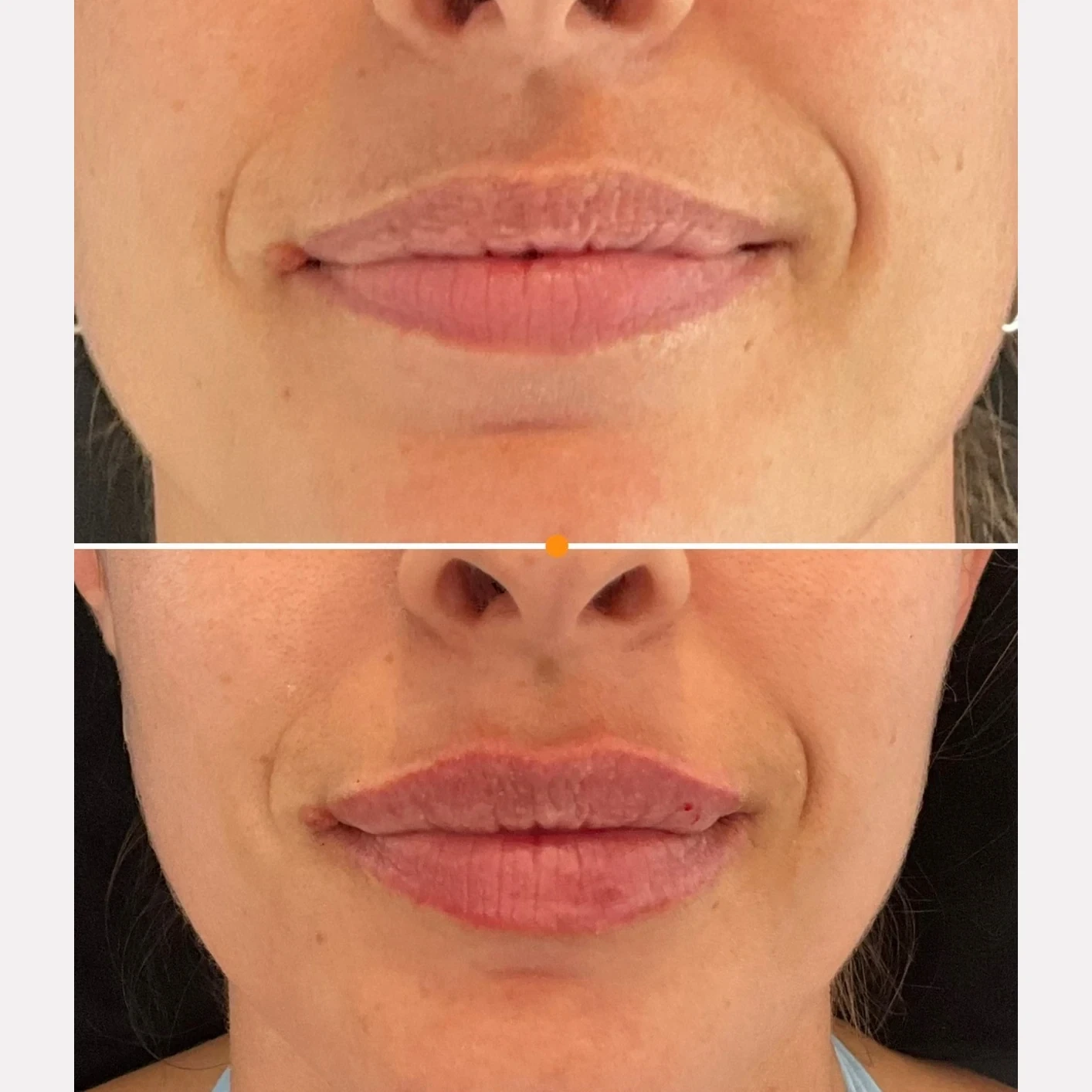 lip filler before and after in Phoenix