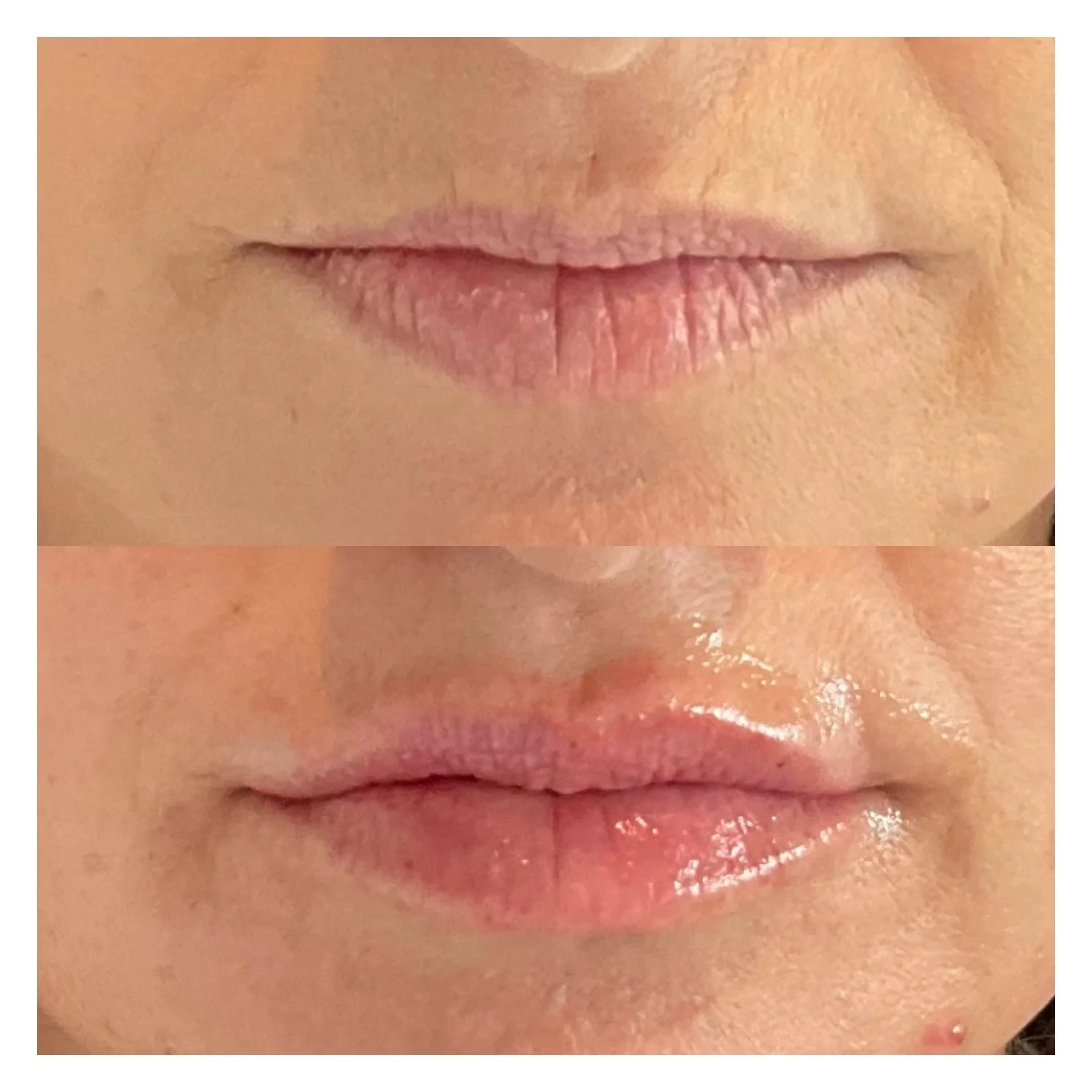 lip filler before and after in Phoenix