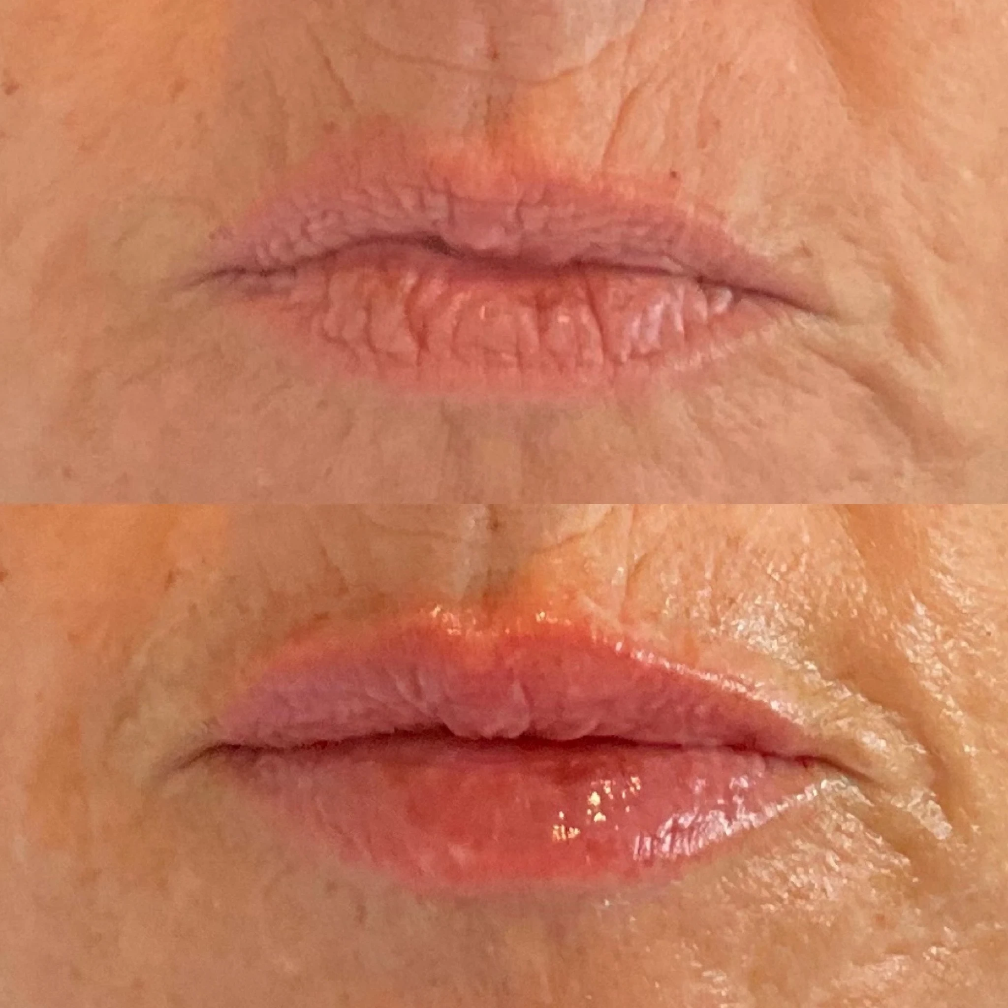 lip filler before and after in Phoenix