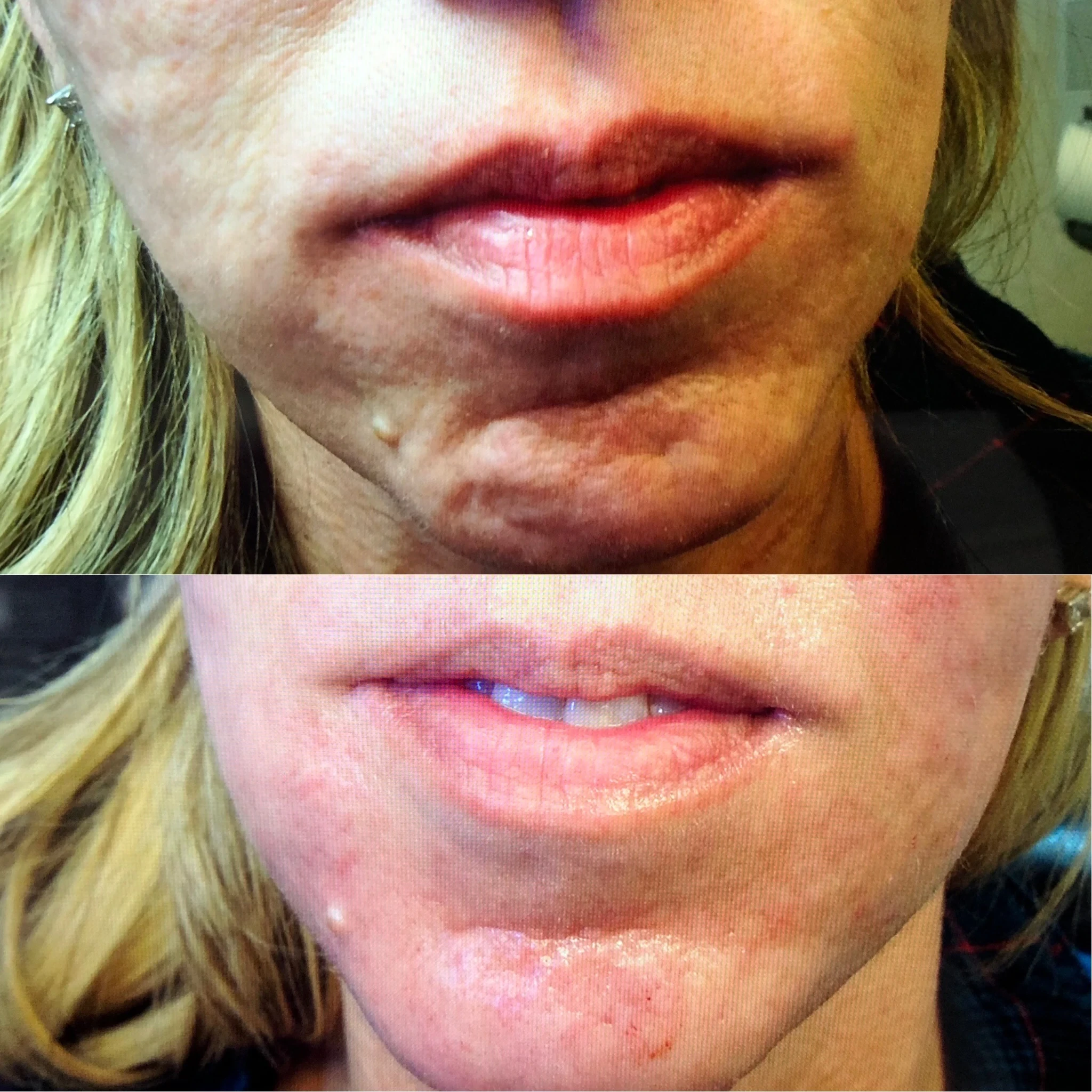 lip filler before and after in Phoenix
