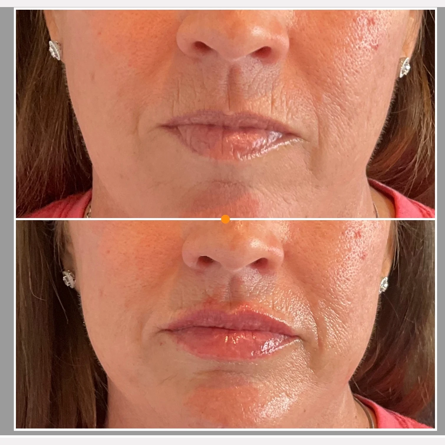 lip filler before and after in Phoenix