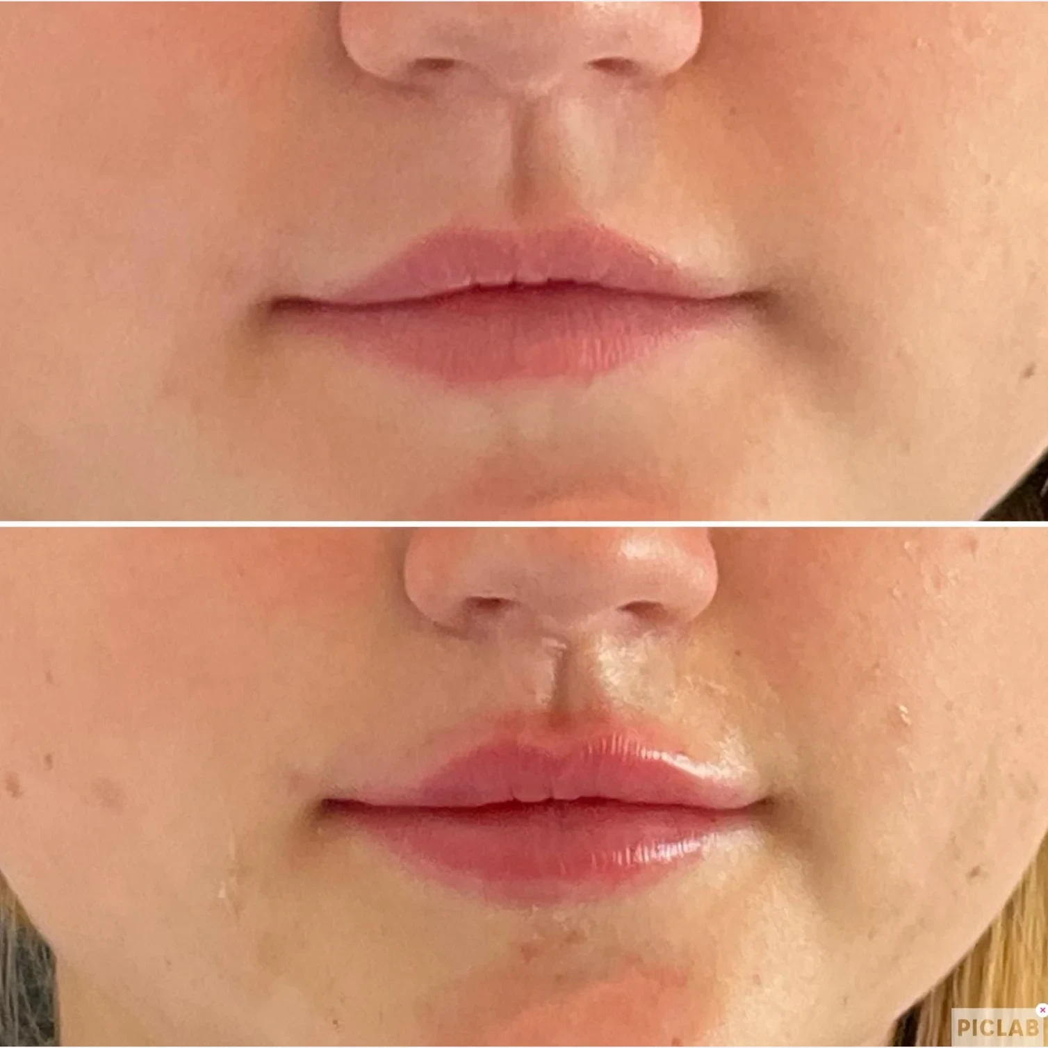 lip filler before and after in Phoenix