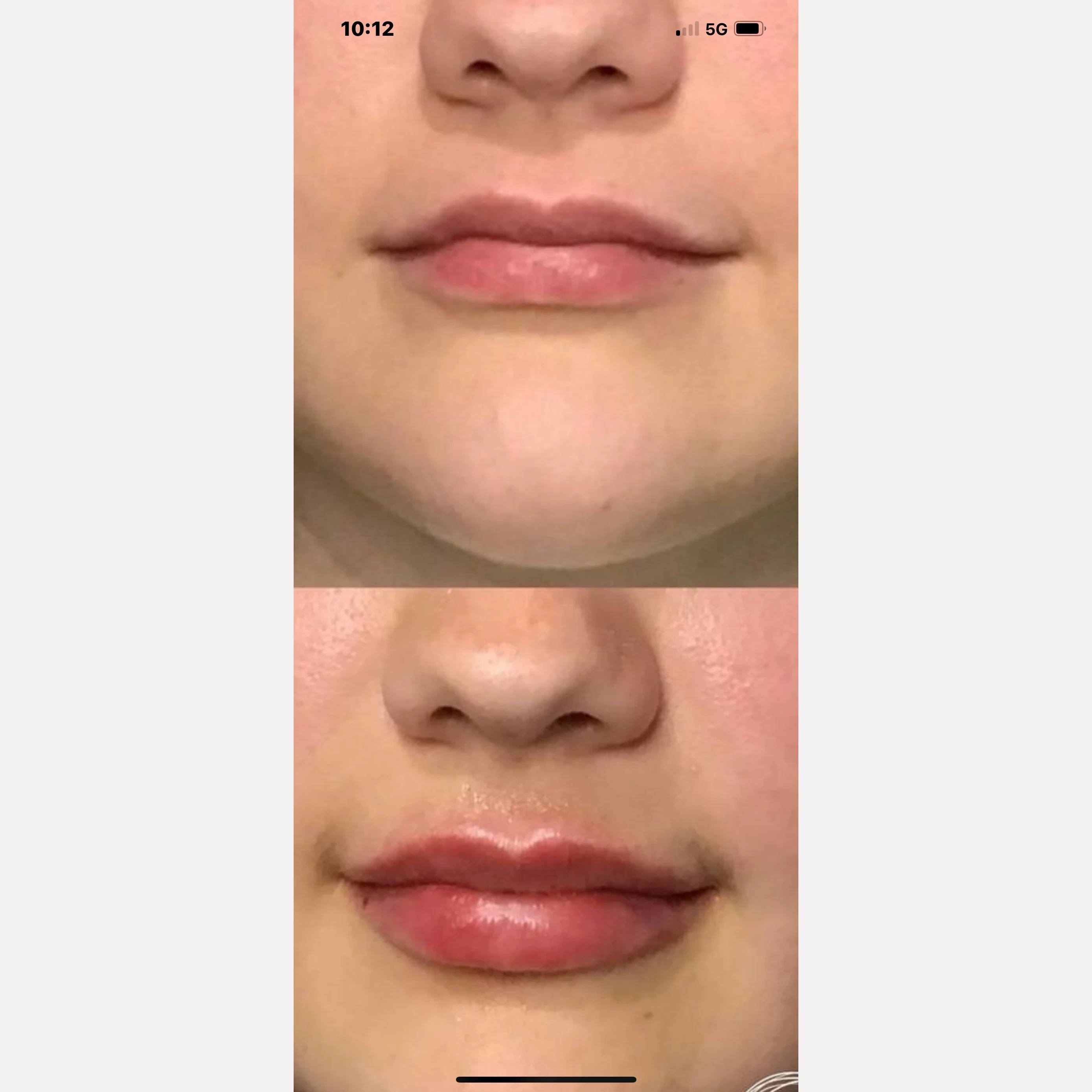 lip filler before and after in Phoenix