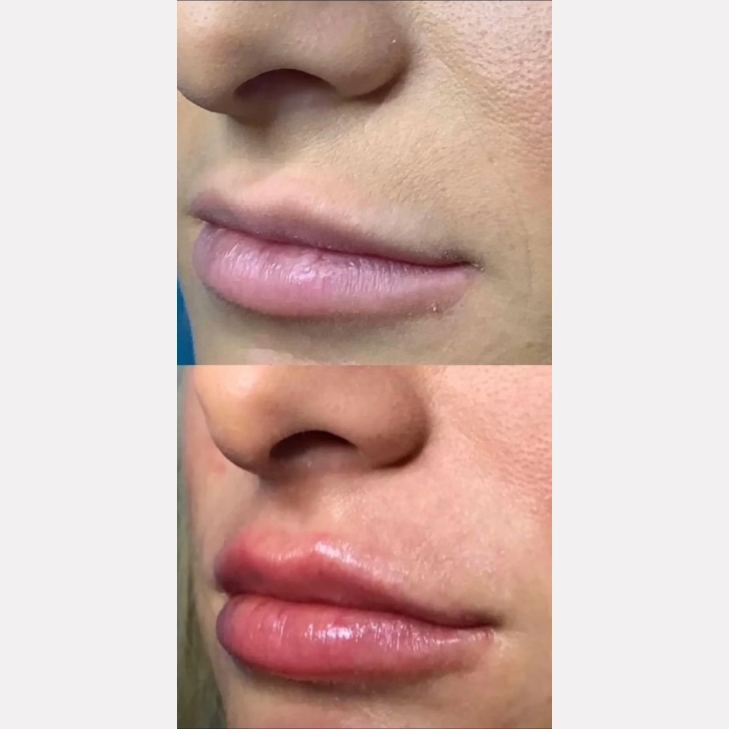 lip filler before and after in Phoenix