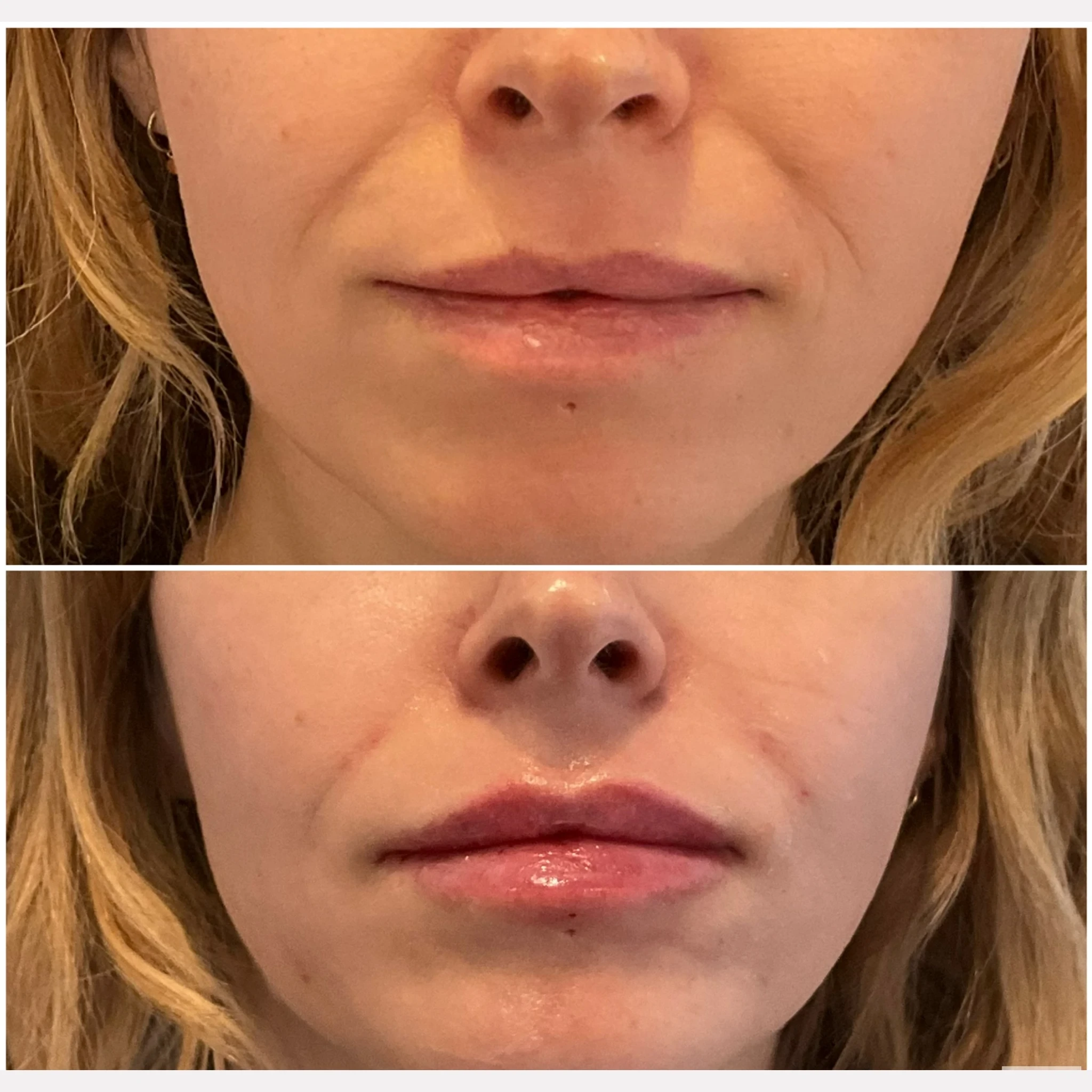 lip filler before and after in Phoenix