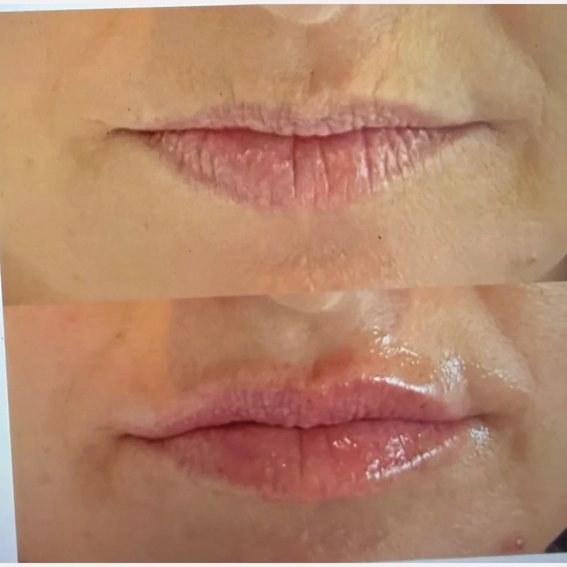 lip filler before and after in Phoenix