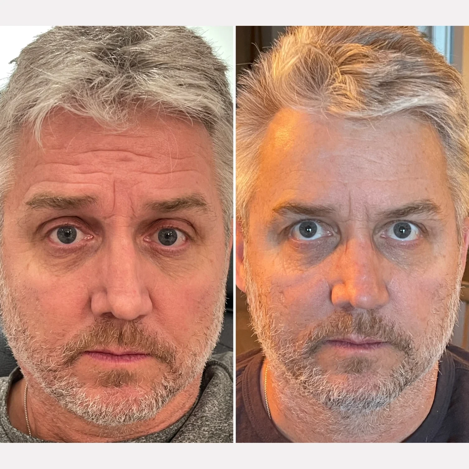 botox before and after in Phoenix
