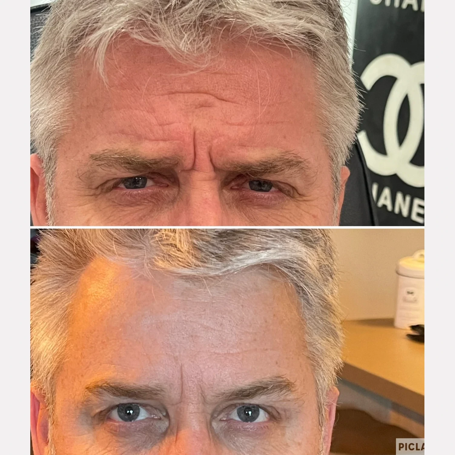 botox before and after in Phoenix