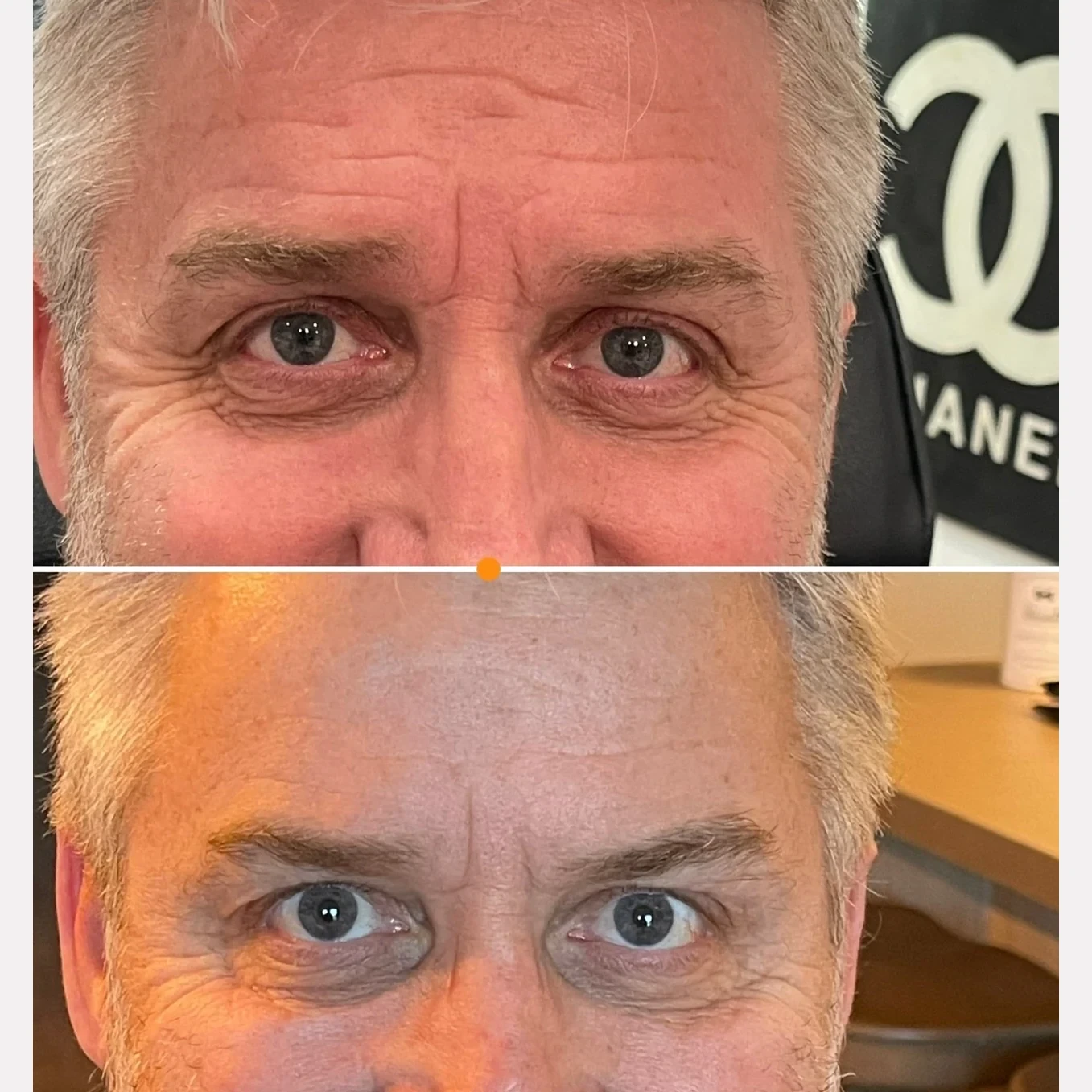 botox before and after in Phoenix