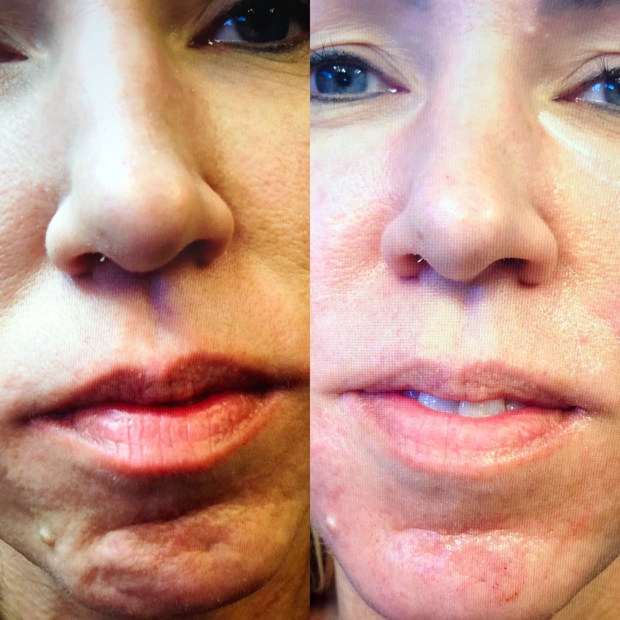 dermal filler before and after in Phoenix
