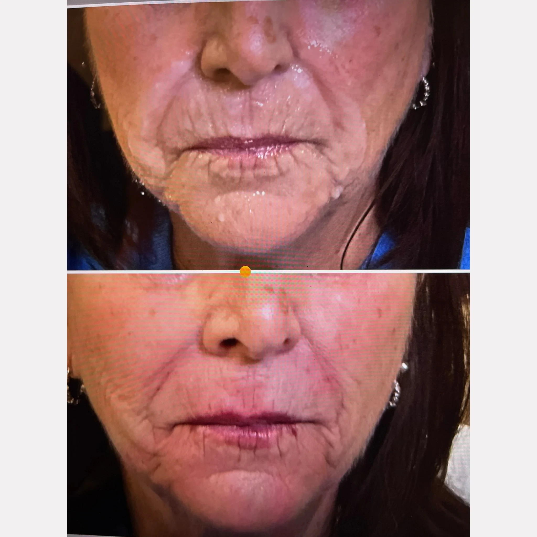 dermal fillers before and after in Phoenix