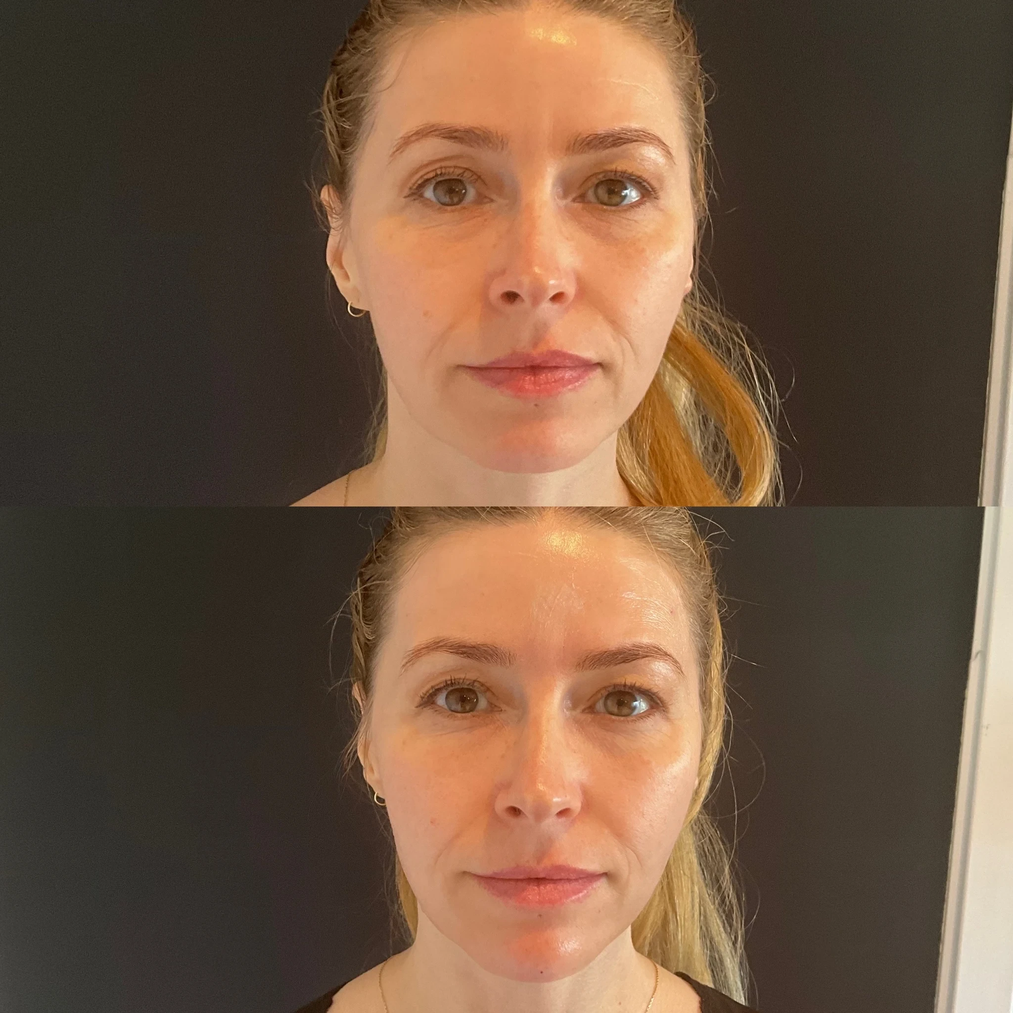facial balancing before and after in Phoenix