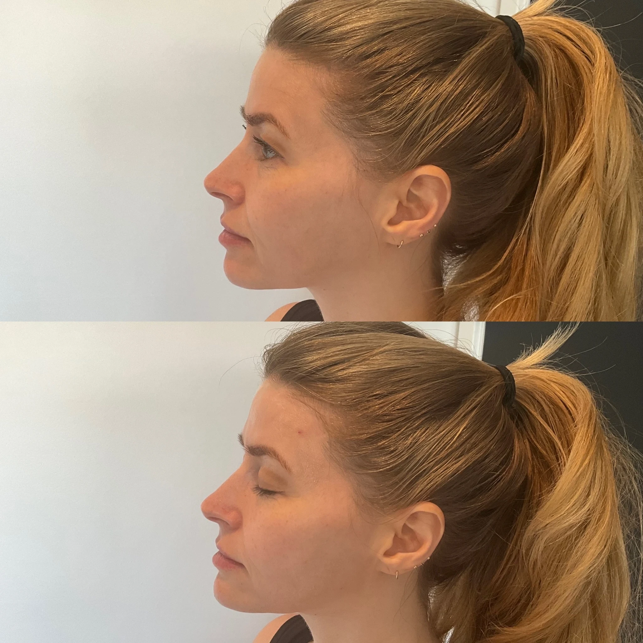 facial balancing before and after in Phoenix
