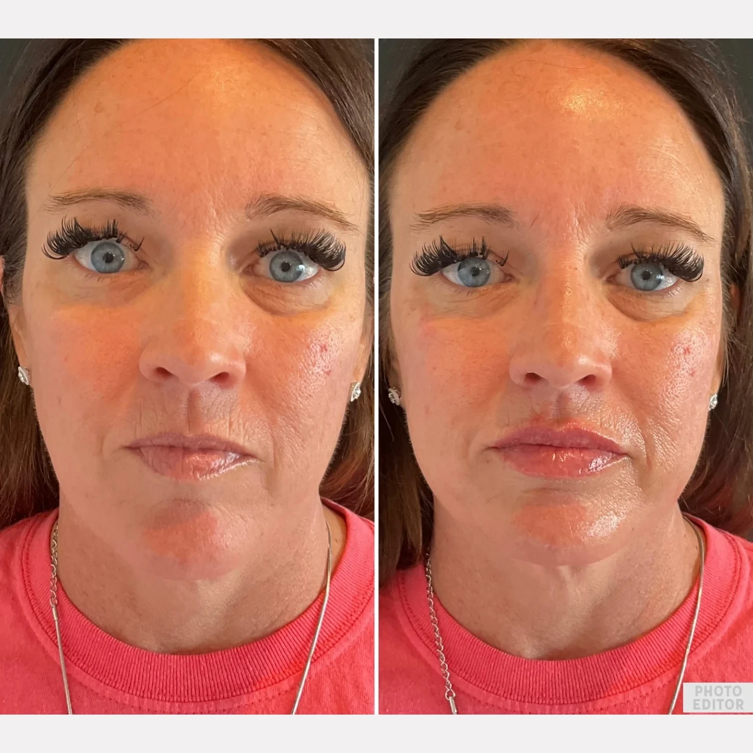 facial balancing before and after in Phoenix