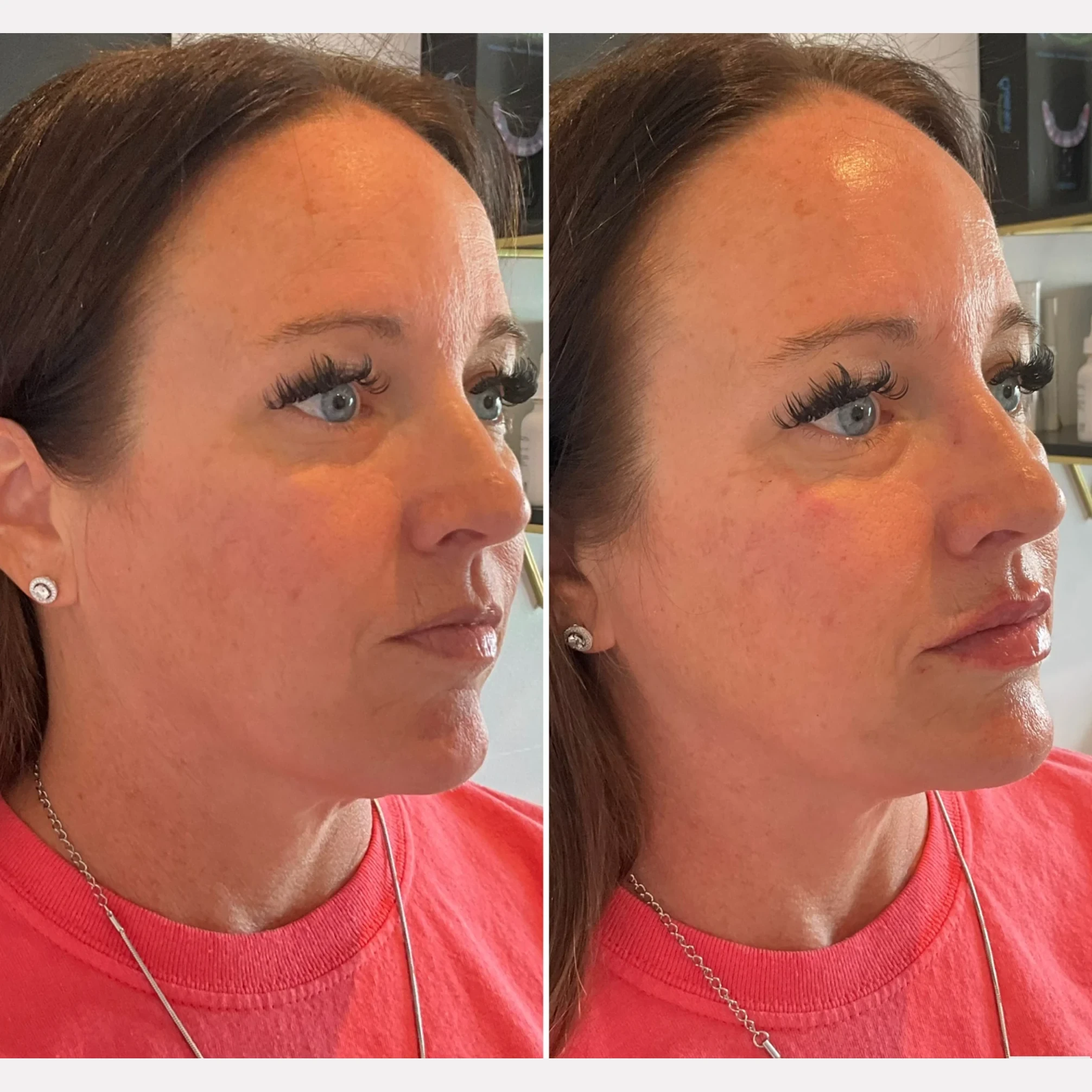 facial balancing before and after in Phoenix