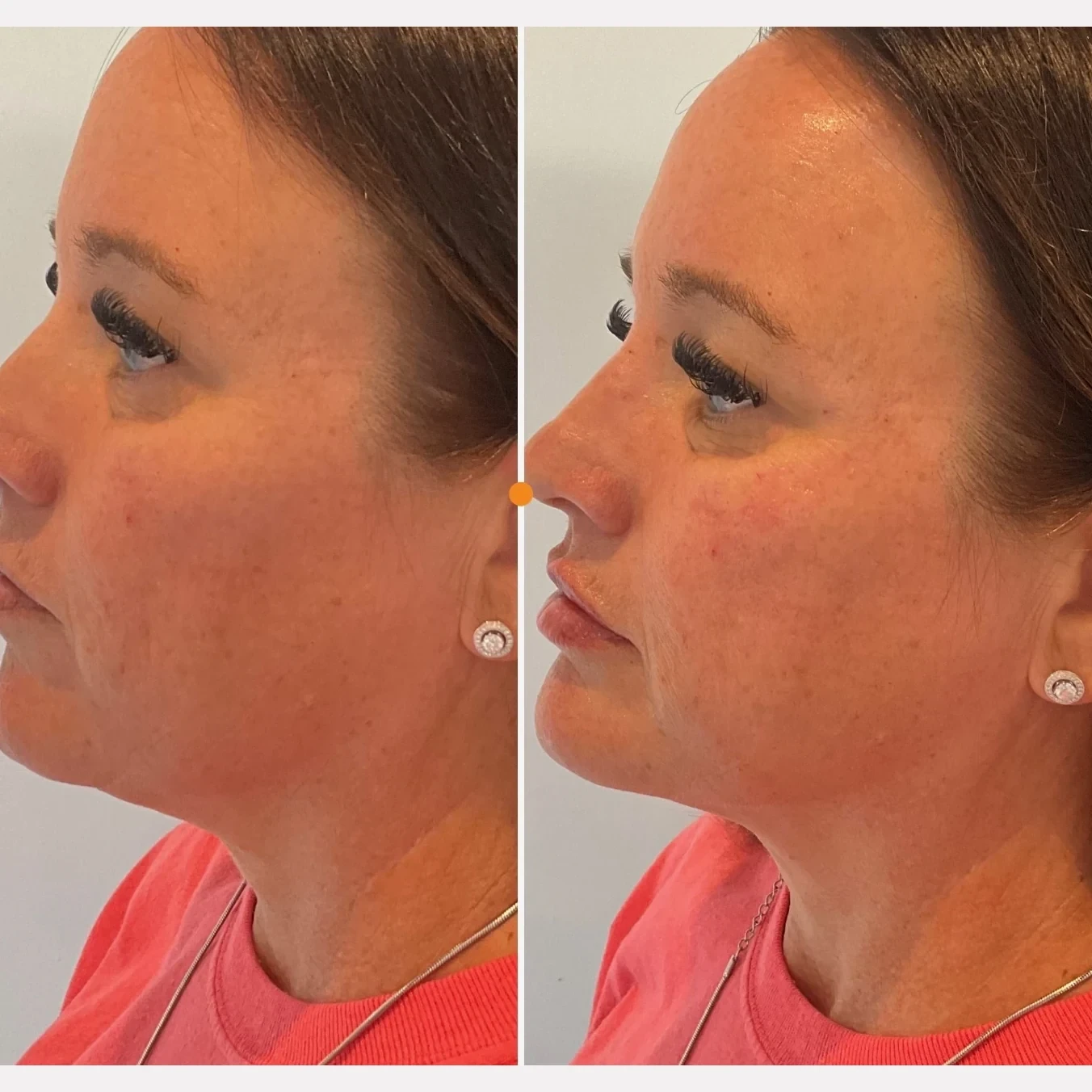 facial balancing before and after in Phoenix