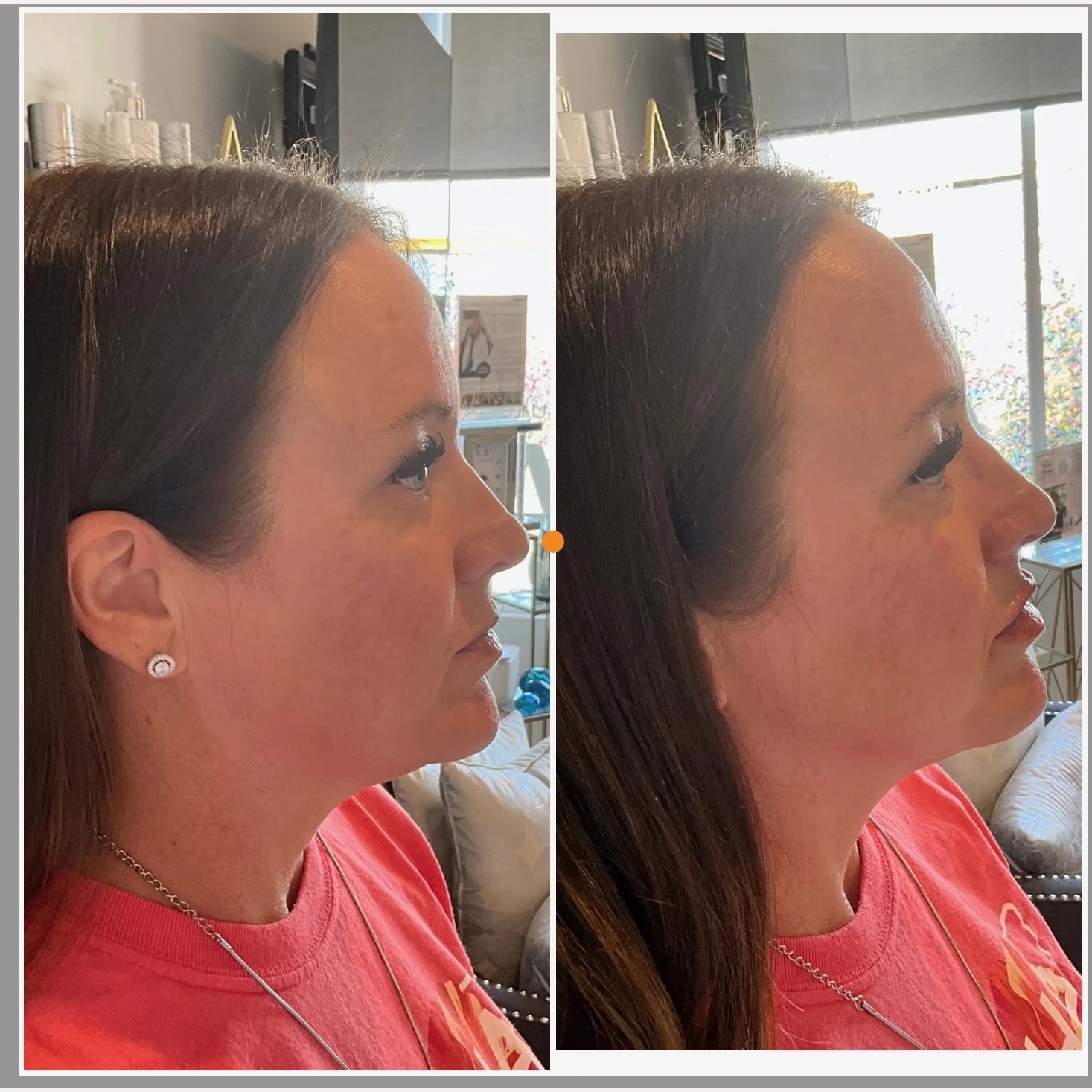 facial balancing before and after in Phoenix