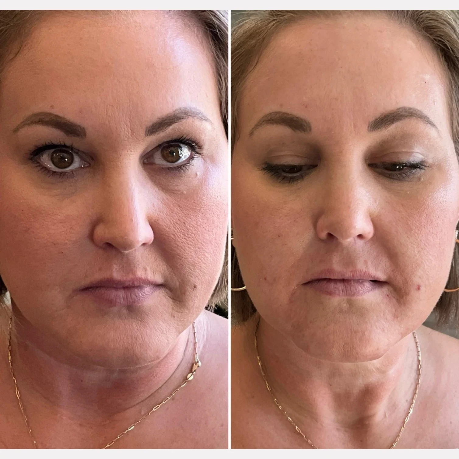 facial balancing before and after in Phoenix