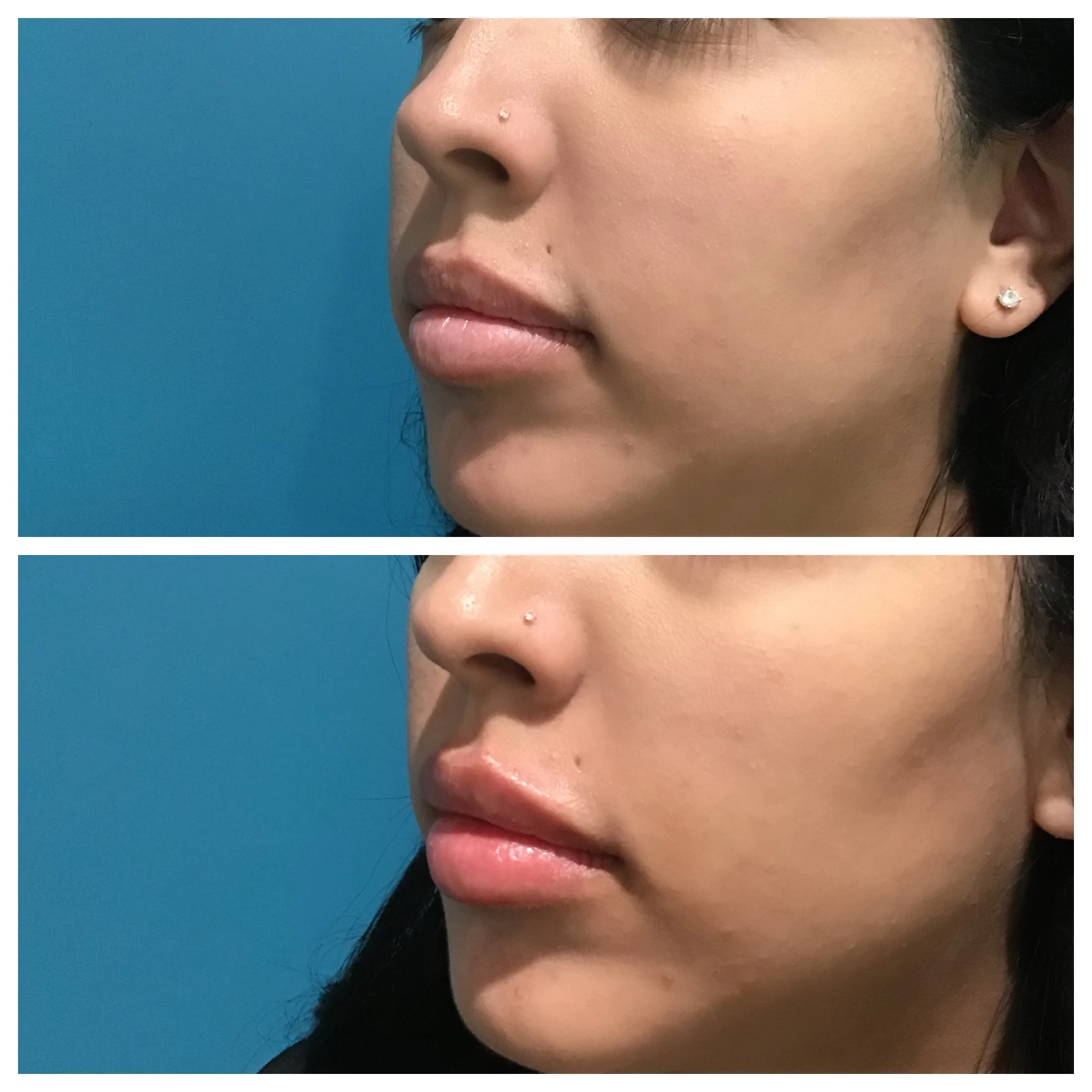 facial balancing before and after in Phoenix