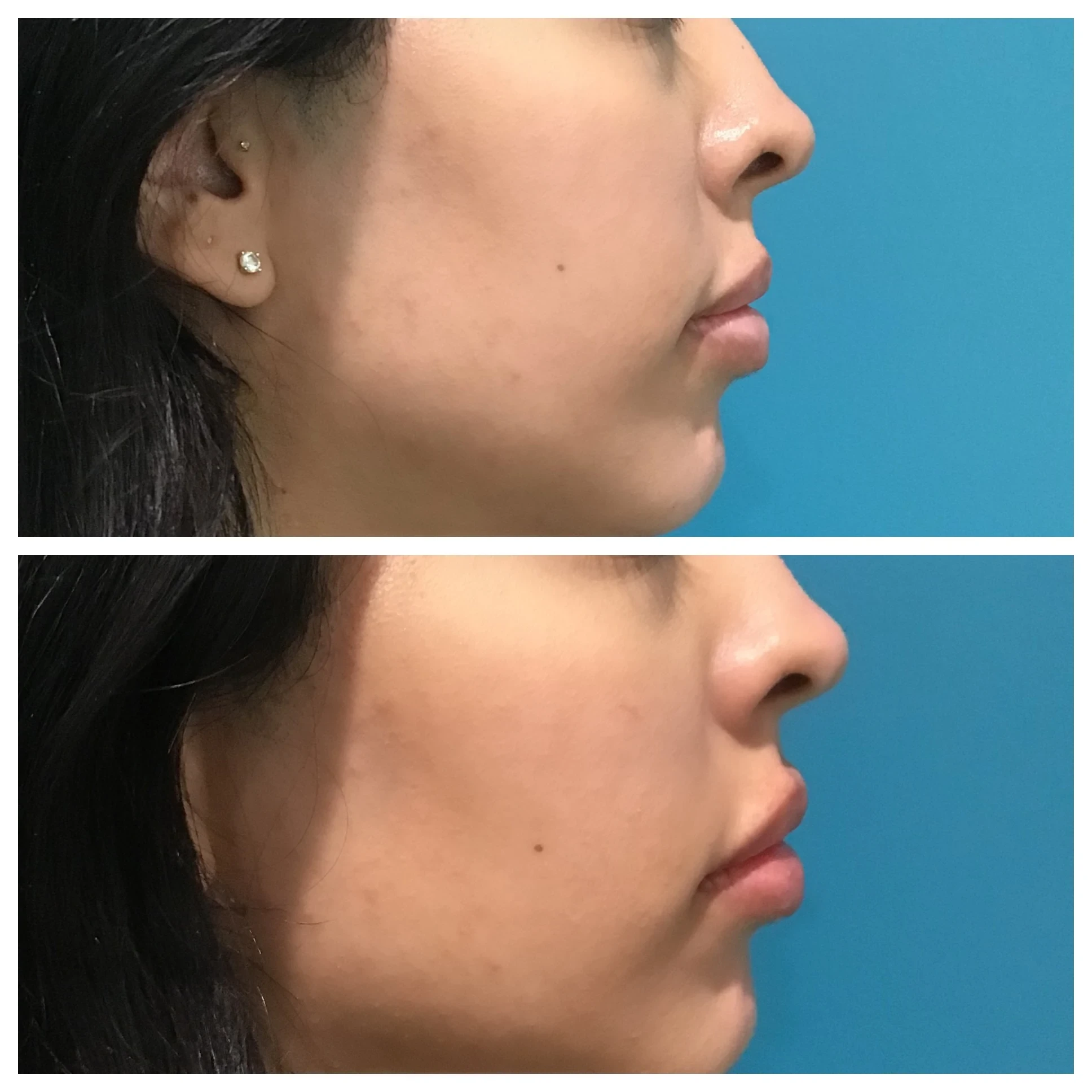 facial balancing before and after in Phoenix