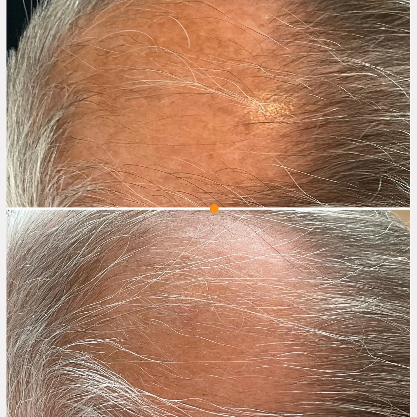 hair restoration before and after in Phoenix