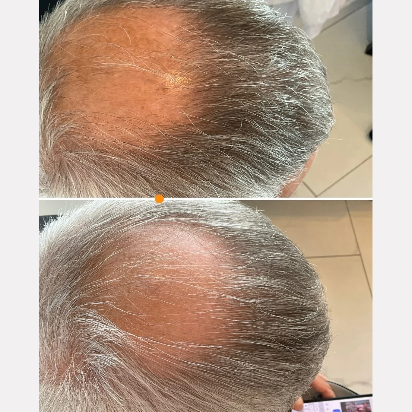 hair restoration before and after in Phoenix