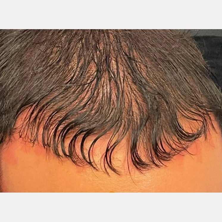 hair restoration before and after in Phoenix