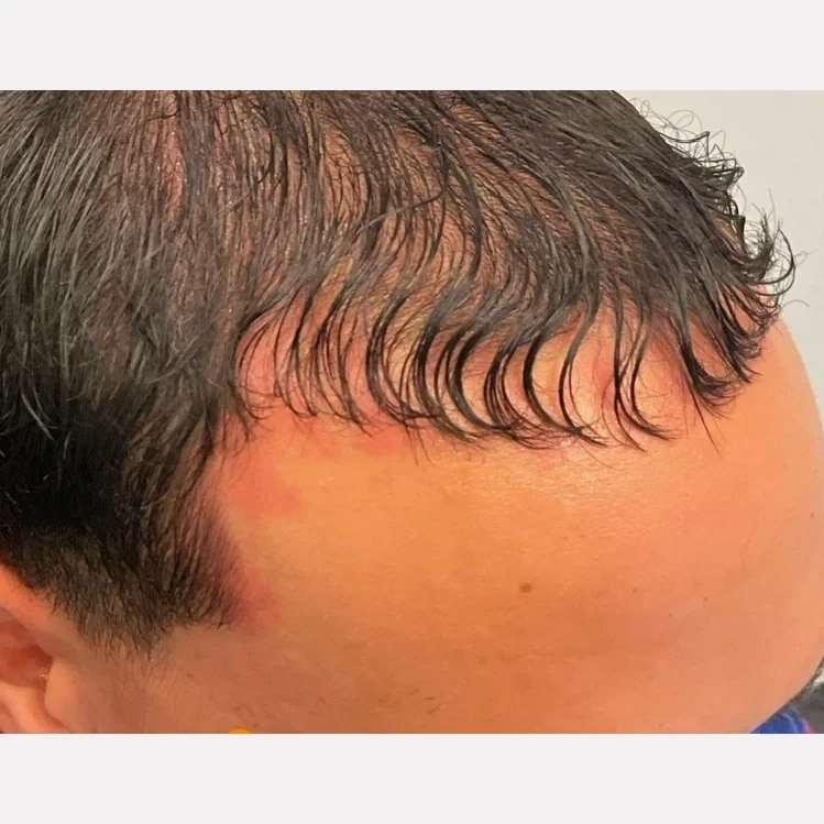 hair restoration before and after in Phoenix
