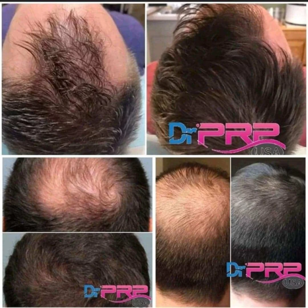 hair restoration before and after in Phoenix