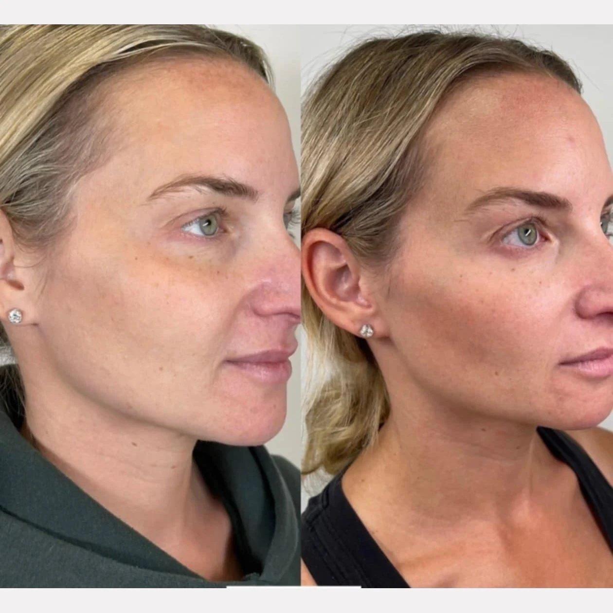 prp facial before and after in Phoenix