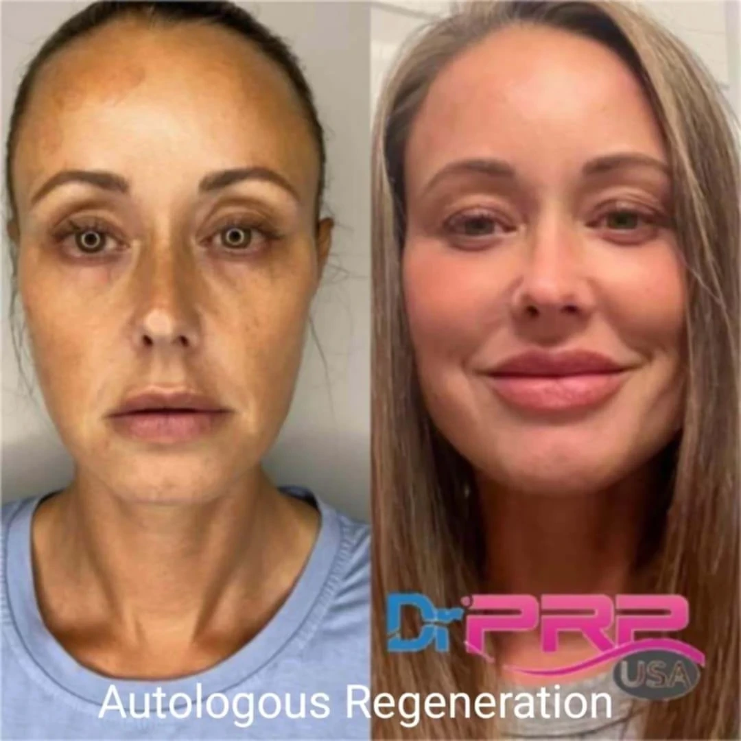 prp & prf before and after in Phoenix