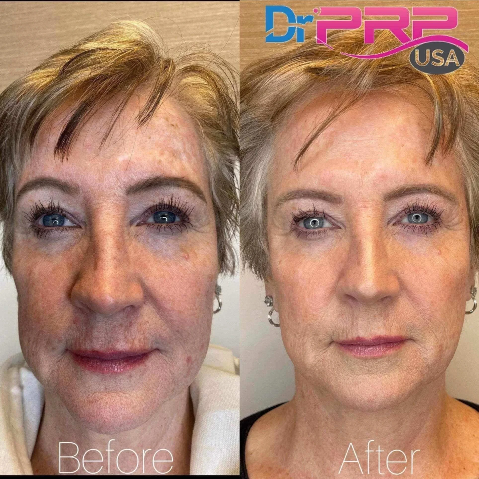 prp & prf before and after in Phoenix