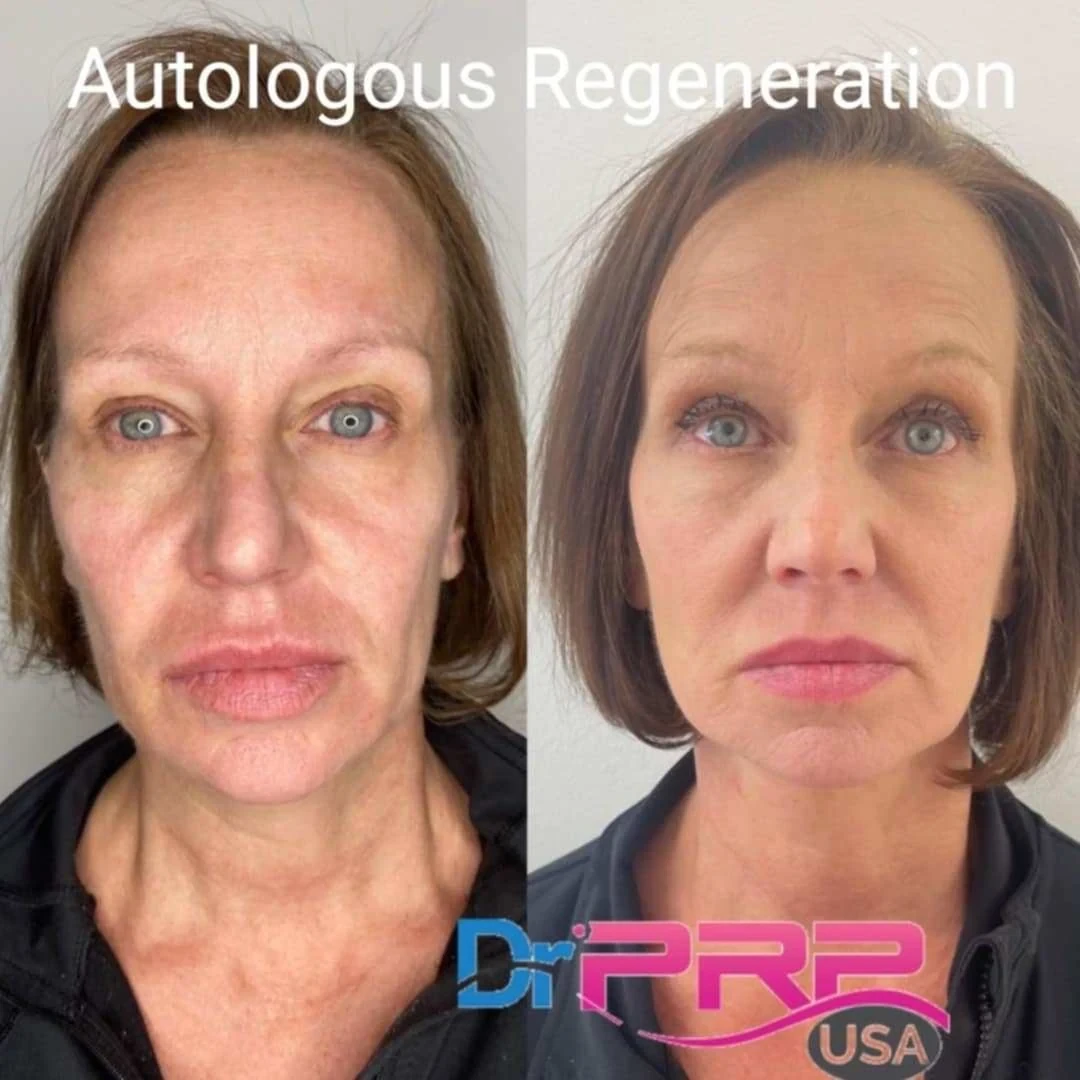 prp & prf before and after in Phoenix