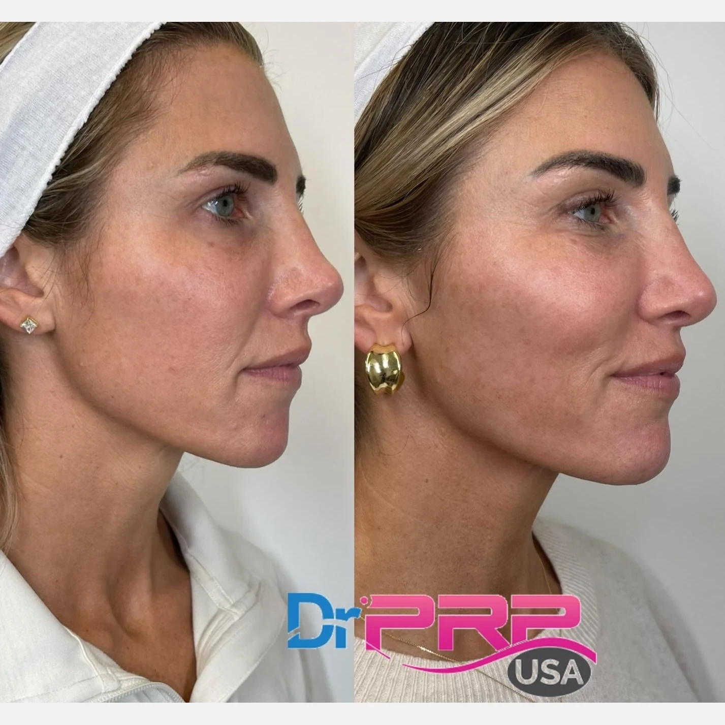 prp & prf before and after in Phoenix
