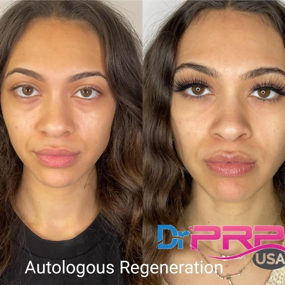 prp & prf before and after in Phoenix