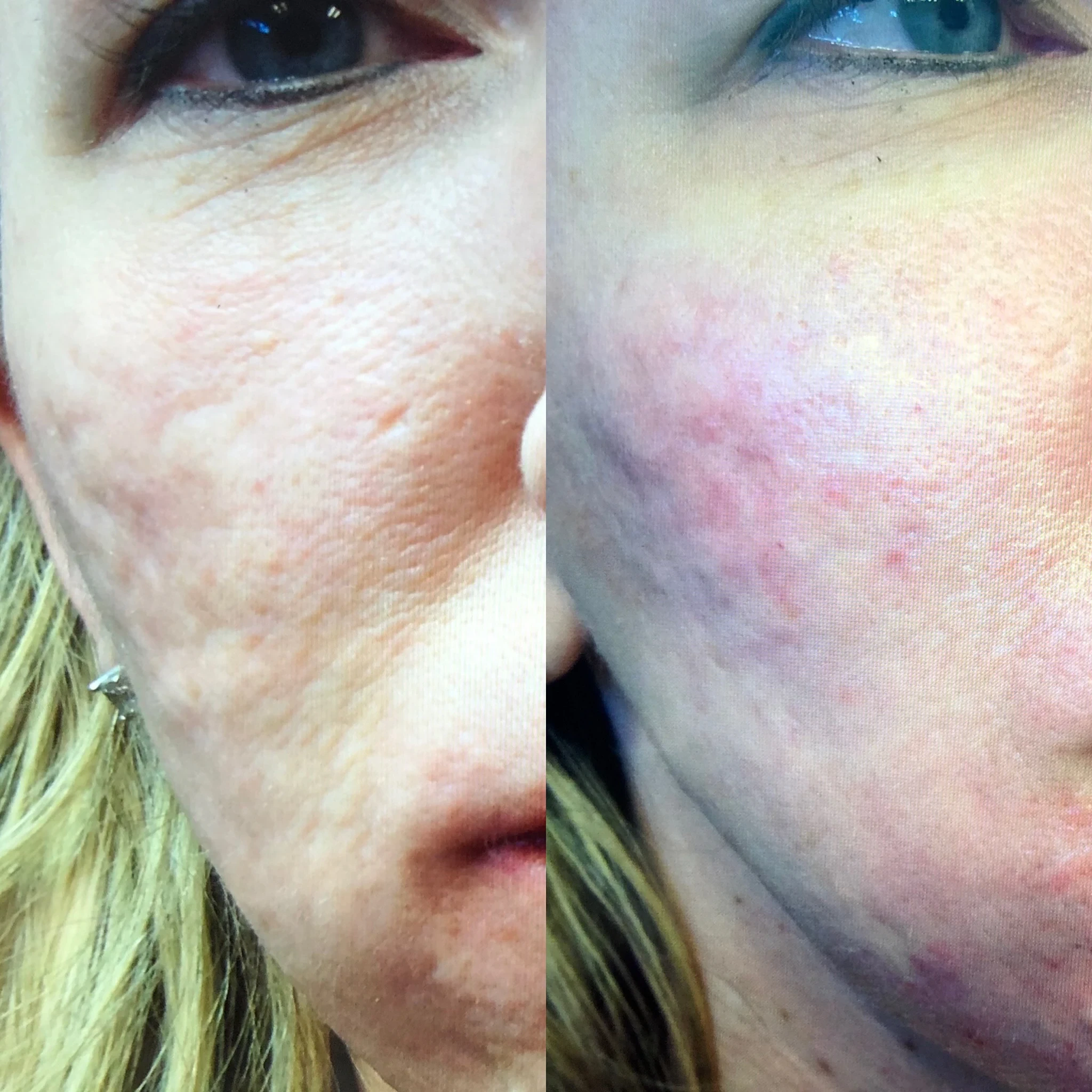 skin rejuvenation before and after in Phoenix