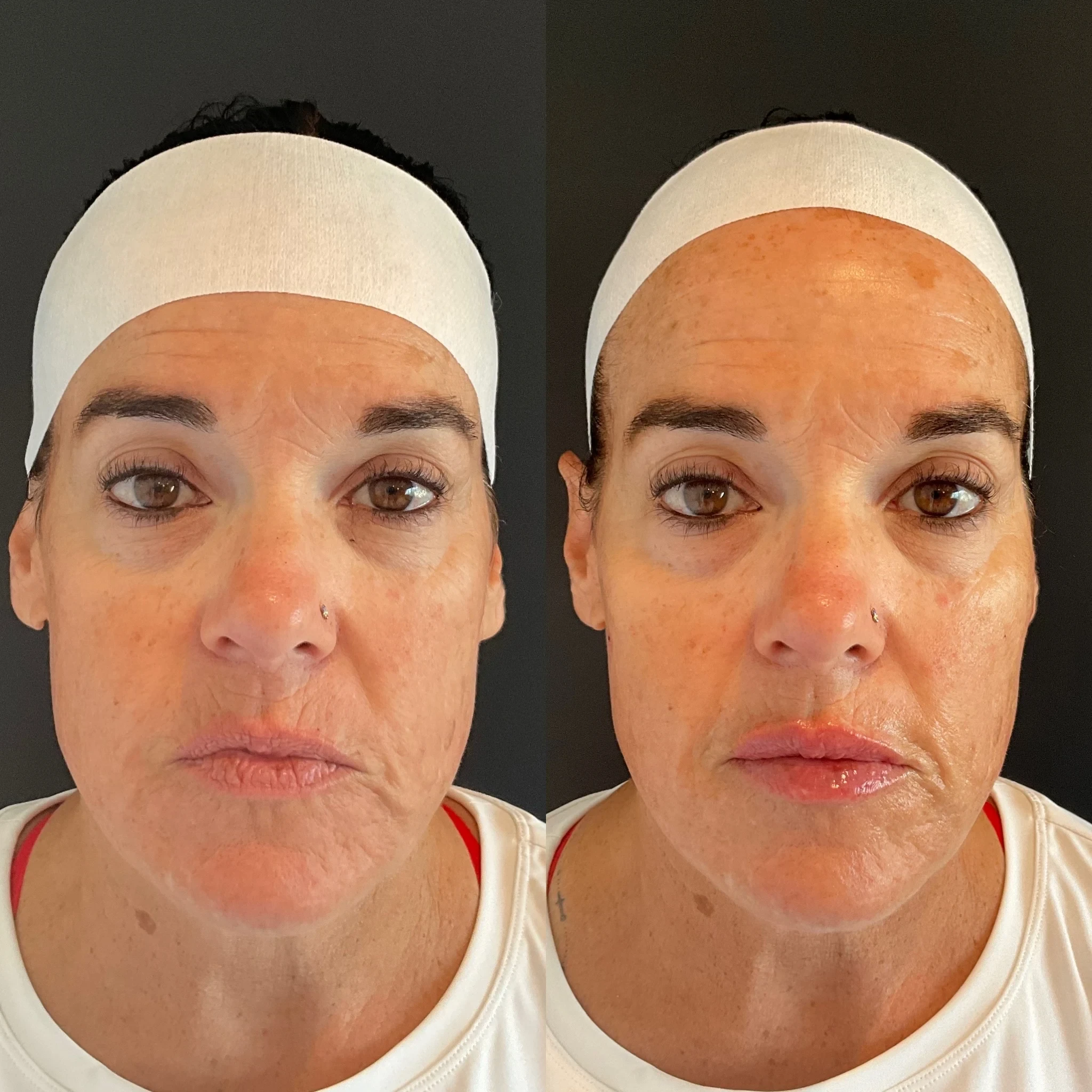 skin rejuvenation before and after in Phoenix
