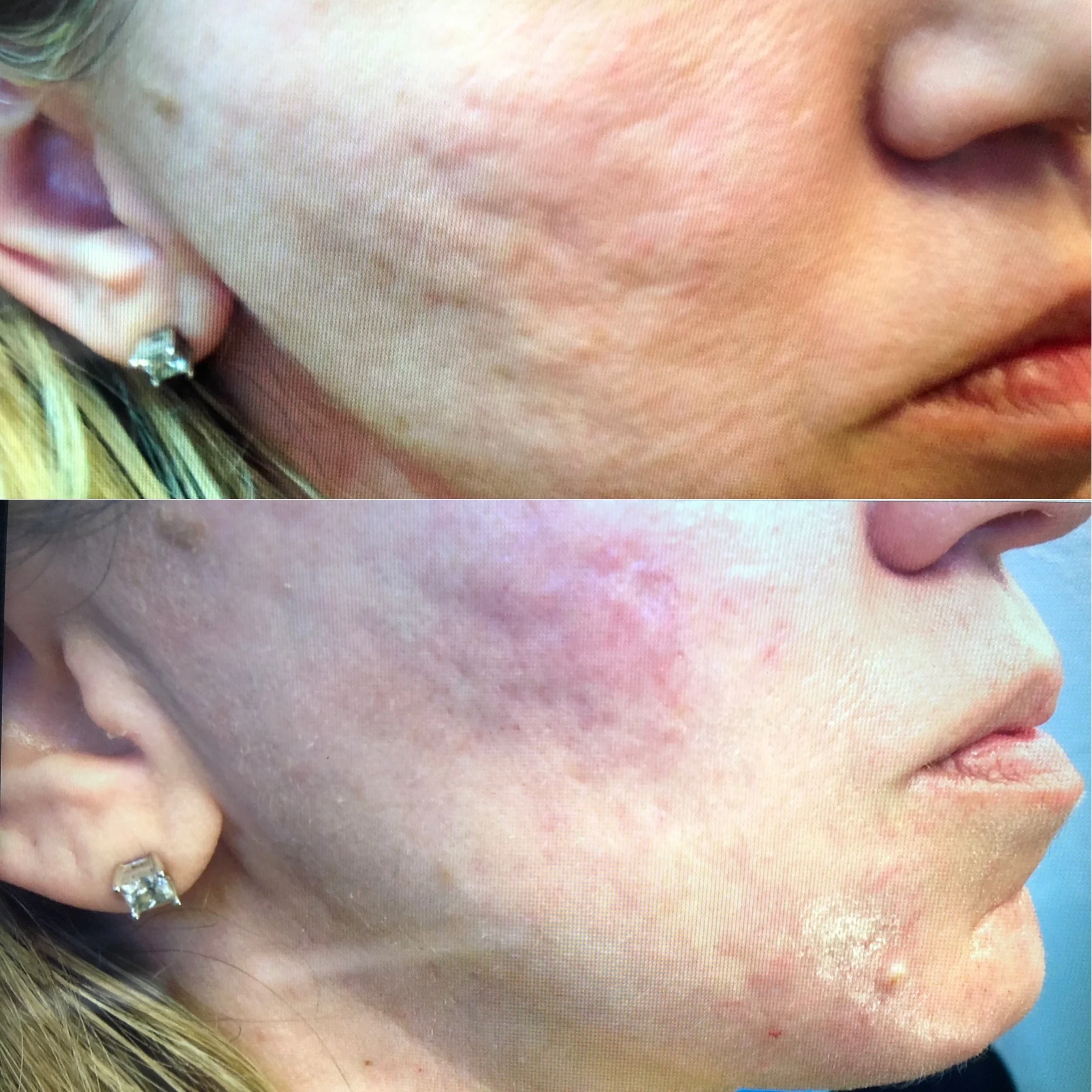 skin rejuvenation before and after in Phoenix