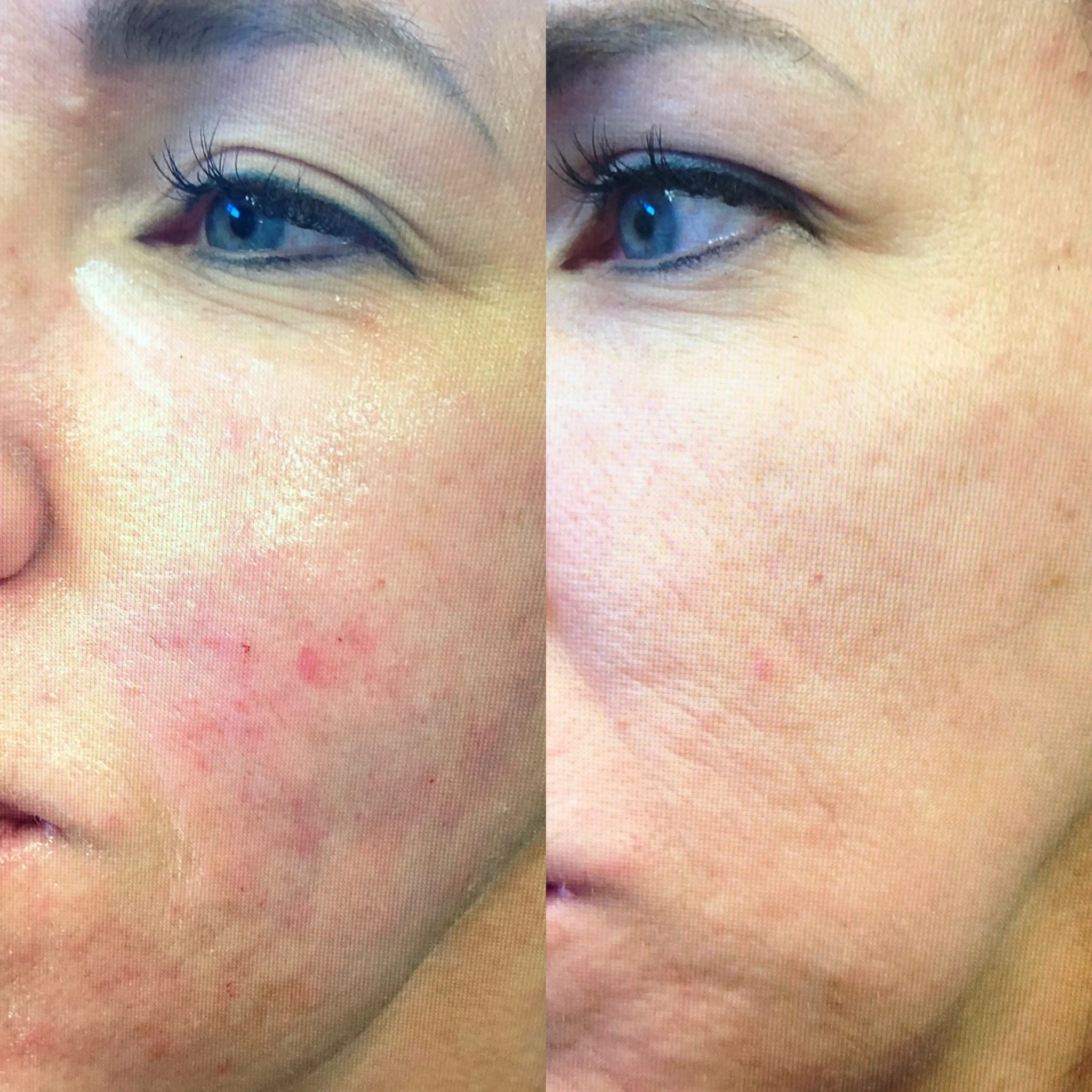 skin rejuvenation before and after in Phoenix