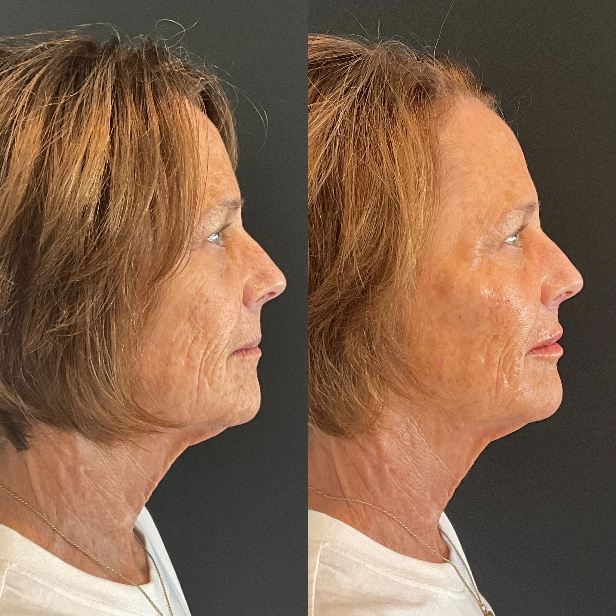 skin rejuvenation before and after in Phoenix