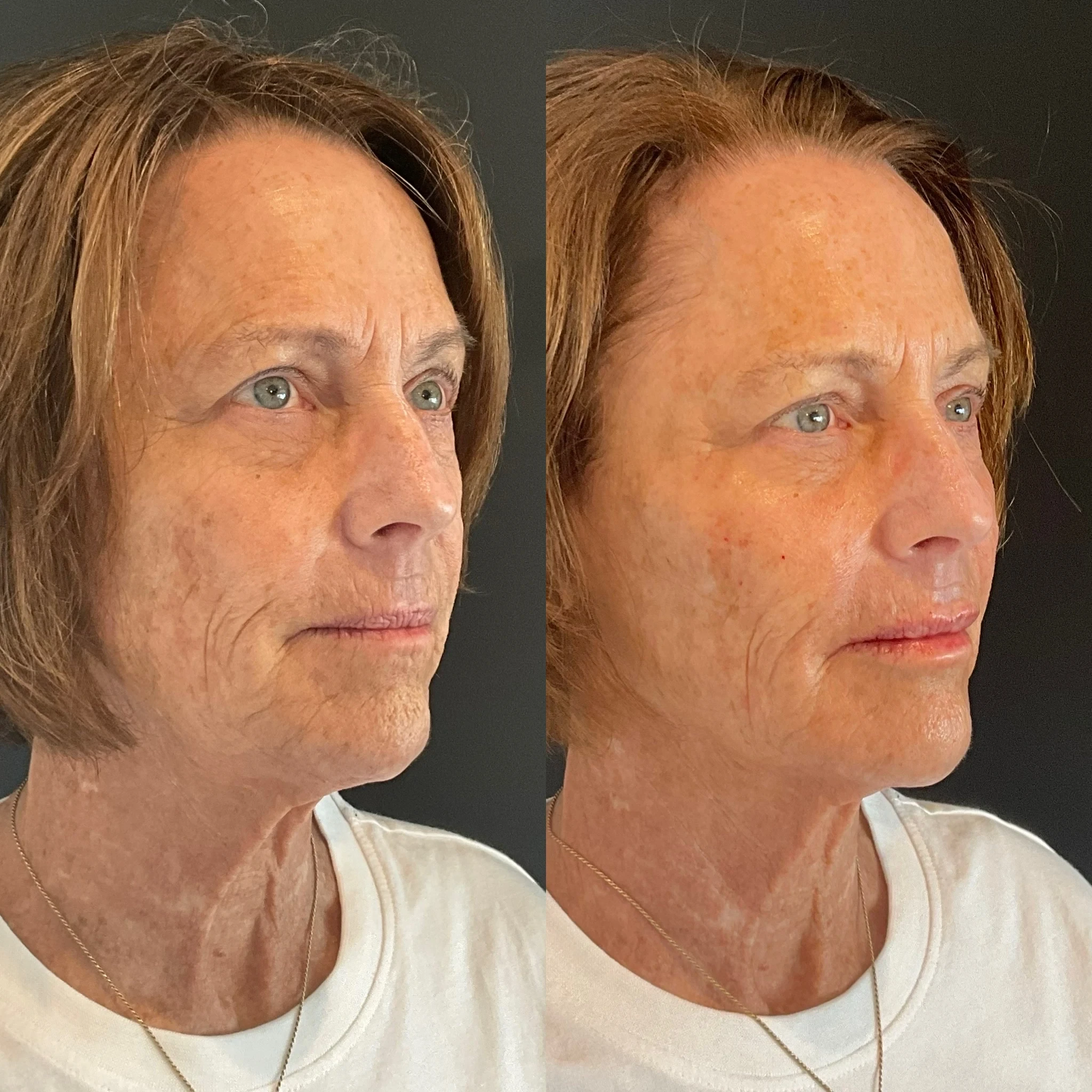 skin rejuvenation before and after in Phoenix