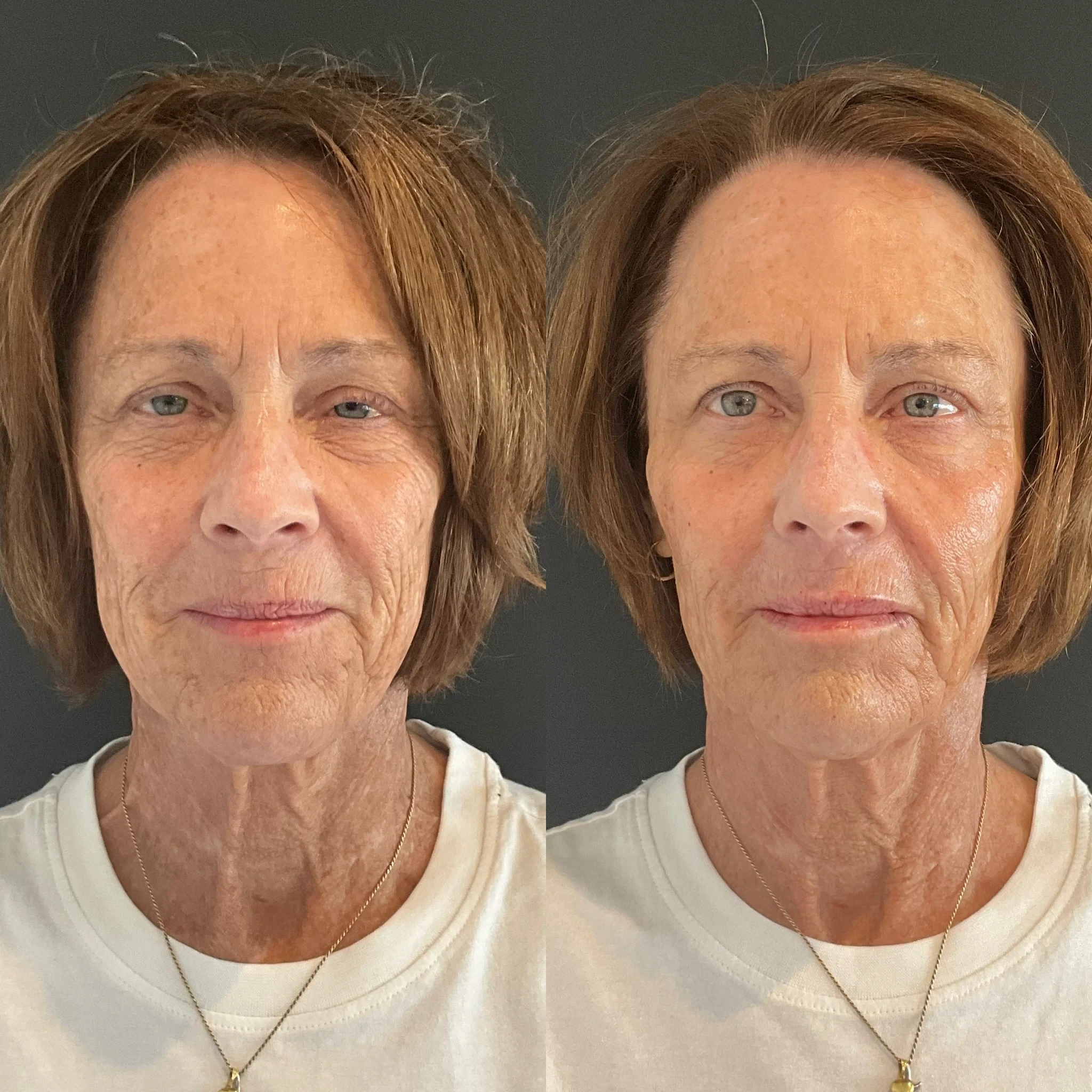 skin rejuvenation before and after in Phoenix