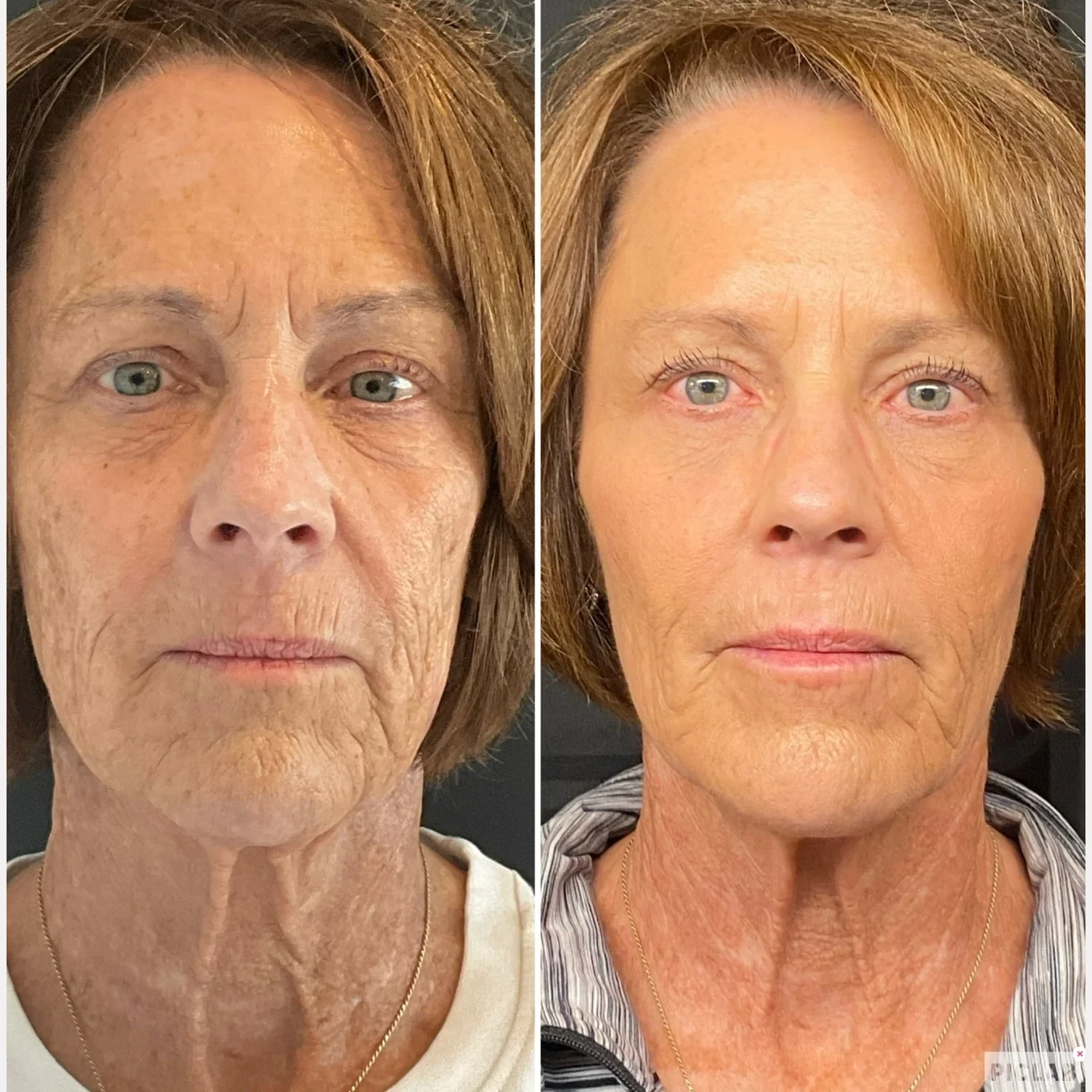 skin rejuvenation before and after in Phoenix