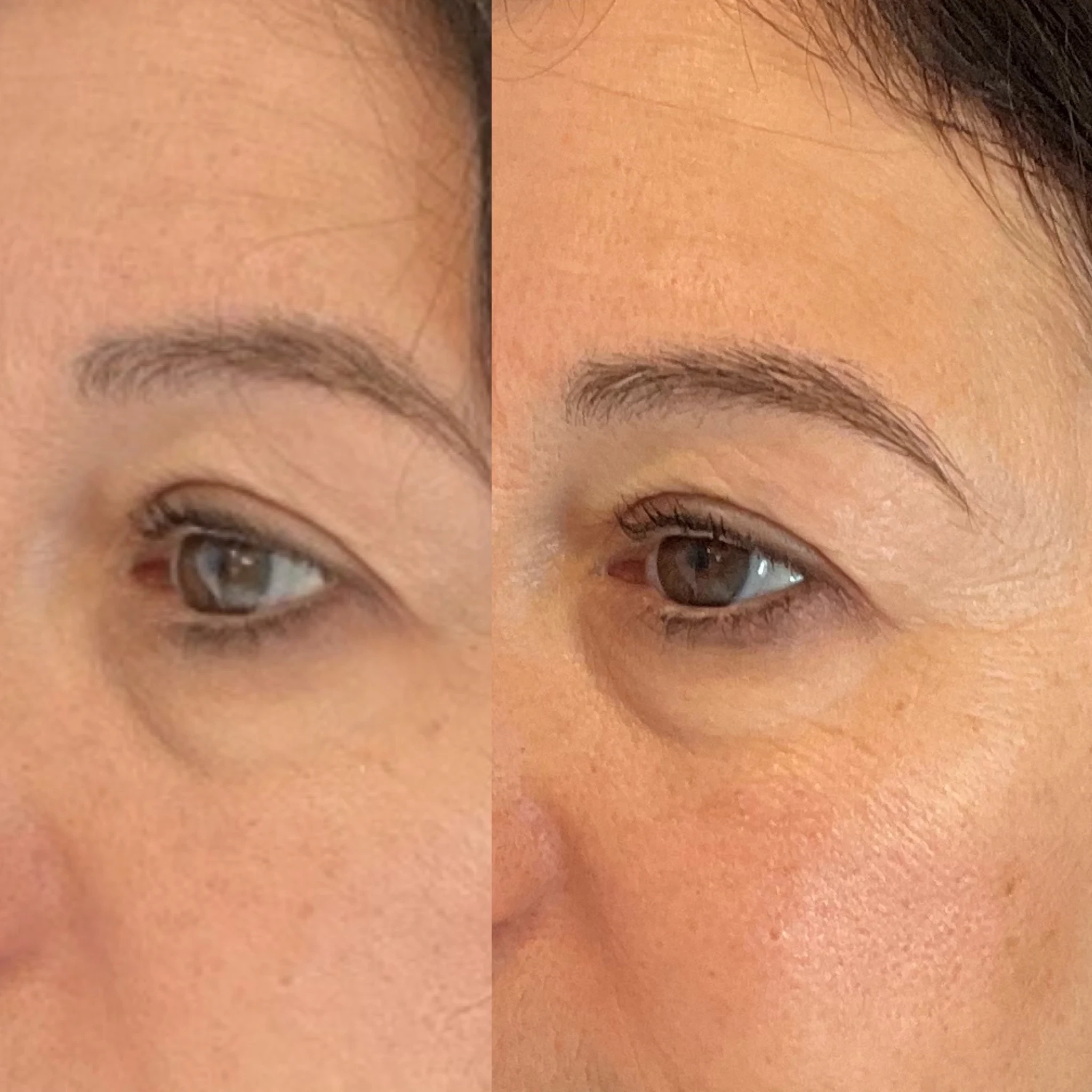 skin rejuvenation before and after in Phoenix